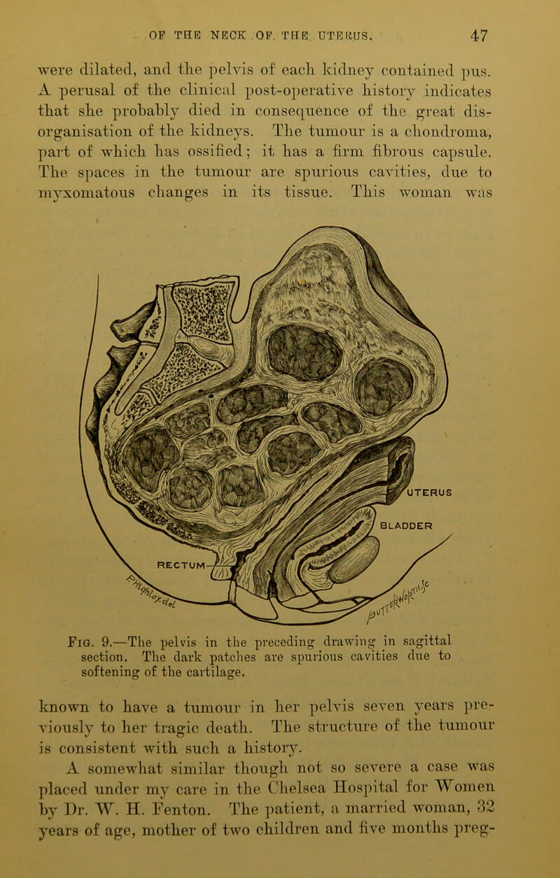 were dilated, and tlie pelvis of each kidney contained pns. A perusal of the clinical post-operative history indicates that she probably died in consequence of the great dis- organisation of the kidneys. The tumour is a chondroma, part of which has ossified; it has a firm fibrous capsule. The spaces in the tumour are spurious cavities, due to myxomatous changes in its tissue. This woman was Fig. 9.—The pelvis in the preceding drawing in sagittal section. The dark patches are spurious cavities due to softening of the cartilage. known to have a tumour in her pelvis seven years pre- viously to her tragic death. The structure of the tumour is consistent with such a histoiy. A somewhat similar though not so severe a case was placed under my care in the Chelsea Hospital for Women by Dr. W. H. Fenton. The patient, a married woman, 32 years of age, mother of two children and five months preg-