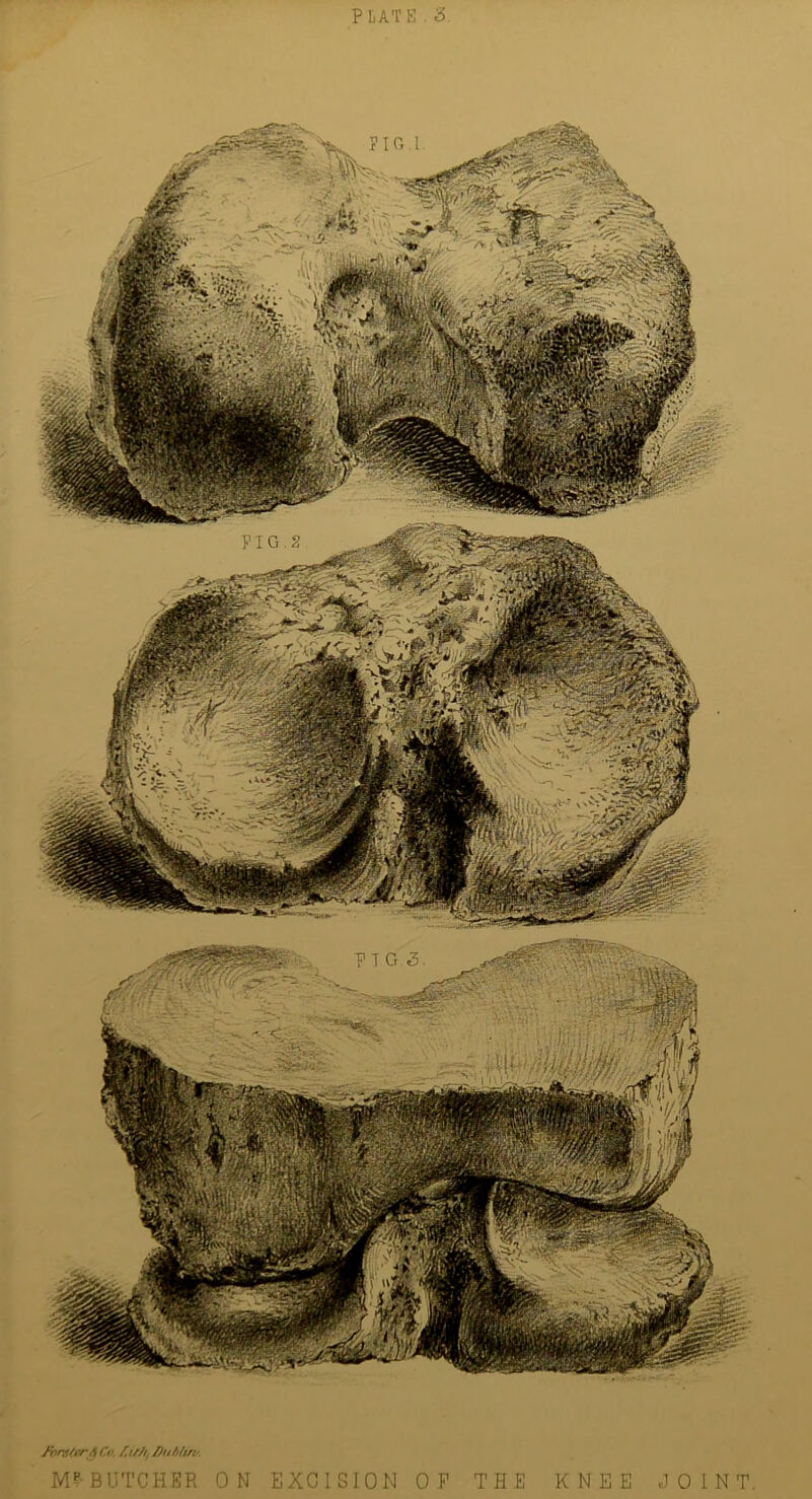 PLATE . 3 F I G . 2 JvnttirA Co. Ait//, Du ft lift/. M?-BUTCHER ON EXCIE SION OP THE KNEE JOINT