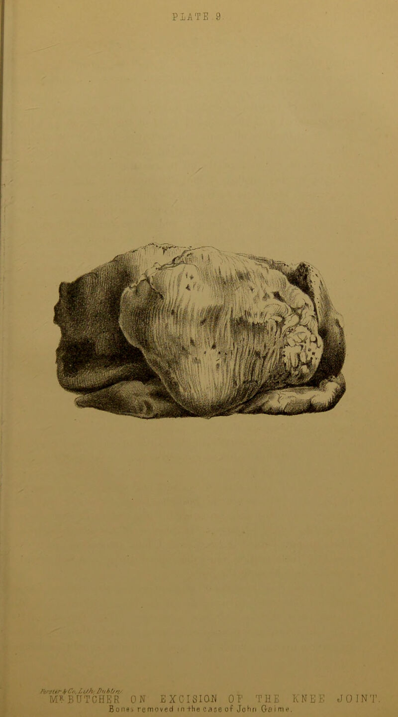 faster &Co, Ltfh Dt/hf/r?' MP BUTCHER ON EXCISION OP THE KNEE JOINT Bonsi removed in the case of John Gaime.