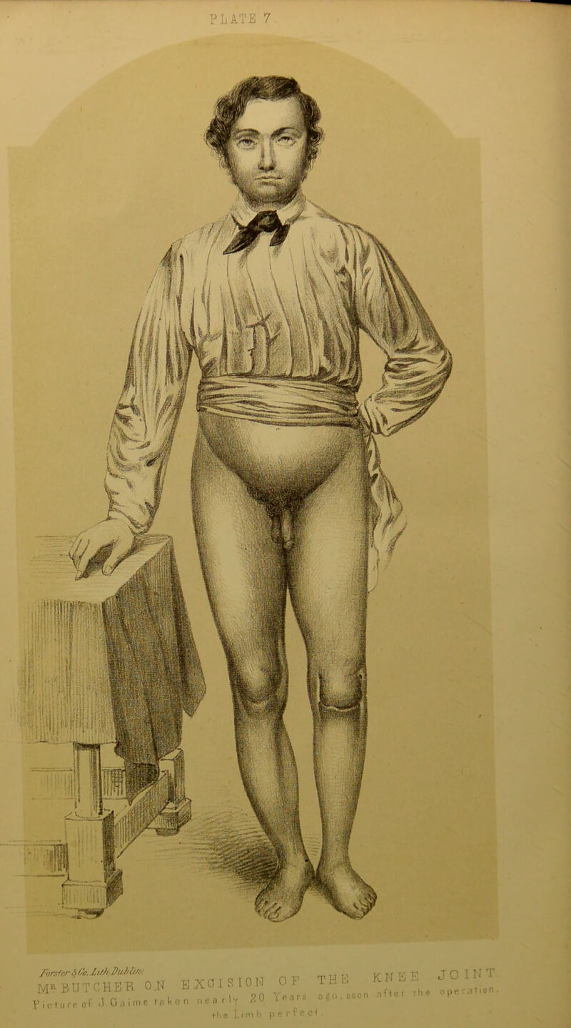 fbrsfcr $ Co. itblif}/ MK BUTCHE~R OP EXCISION Picture of J Gaime taken nearly 20 tl. e L i i’i I’ OF THE Years a$o. soon perfect knee join t. after the operation.