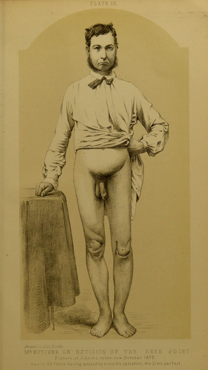 Ft r*trr • • ' D/t& Fa MRBUTCHER ON EXCISION OP THE KNEE JOINT. picture o+ J.Ga i me,taken now,October. 187? n h ,1 I- ivUYear* having passed by since the operation, the Limb perf ect