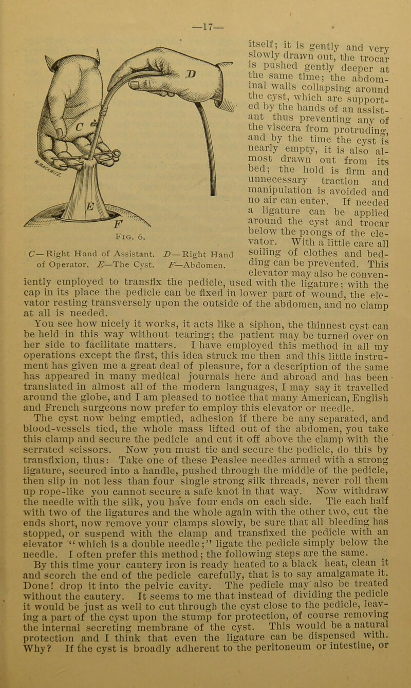 —17— Itself; It is gently and very slowly drawn out, the trocar IS pushed gently deeper at the same time; the abdom- inal walls collapsing around the C}'st, which are support- ed by the hands of an assist- ant thus preventing any of the viscera from pi’otrud'ing, and by the time the cyst is nearly empty, it is also al- most drawn out from its bed; the hold is firm and unnecessary traction and manipulation is avoided and no air can enter. If needed a ligature can be applied around the cyst and trocar below the piongs of the ele- vator. With a'little care all soiling of clothes and bed- ding can be prevented. This elevator may also be conven- iently mnployed to transfix the pedicle, used with the ligature; with the cap in its place the pedicle can be fixed in lower part of wound, the ele- vator resting transversely upon the outside of the abdomen, and no clamp at all is needed. You see how nicely it works, it acts like a siphon, the thinnest cyst can be held in this way without tearing; the patient may be turned over on her side to facilitate matters. I have employed this method in all my operations except the first, this idea struck me then and this little instru- ment has given me a great deal of pleasure, for a description of the same has appeared in many medical journals here and abroad and has been • translated in almost all of the modern languages, I may say it travelled around the globe, and I am pleased to notice that many American, English and Ereuch surgeons now prefer to employ this elevator or needle. The cyst now being emptied, adhesion if there be any separated, and blood-vessels tied, the whole mass lifted out of the abdomen, you take this clamp and secure the pedicle and cut it off above the clamp with the serrated scissors. Now yon must tie and secure the pedicle, do this by transfixion, thus: Take one of these Peaslee needles armed with a strong ligature, secured into a handle, pushed through the middle of the pedicle, then slip in not less than four single strong silk threads, never roll them up rope-like you cannot secure a safe knot in that way. Now withdraw the needle with the silk, you haVe four ends on each side. Tie each half with two of the ligatures and the whole again with the other two, cut the ends short, now remove your clamps slowlj'’, be sure that all bleeding has stopped, or suspend with the clamp and transfixed the pedicle with an elevator “ which is a double needle;” ligate the pedicle simply below the needle. I often prefer this method; the following steps are the same. By this time your cautery iron is ready heated to a black heat, clean it and scorch the end of the pedicle carefully, that is to say amalgamate it. Done! drop it into the pelvic cavity. The pedicle may also be treated without the cautery. It seems to me that instead of dividing the pedicle it would be just as well to cut through the cyst close to the pedicle, leav- ing a part of the cyst upon the stump for protection, of course removing the internal secreting membrane of the cyst. This would be a natural protection and I think that even the ligature can be dispensed with. Why? If the cyst is broadly adherent to the peritoneum or intestine, or B'ig. 6. C—Right Hand of Assistant. D — Right Hand of Operator. E—The Cyst. F—Abdomen.