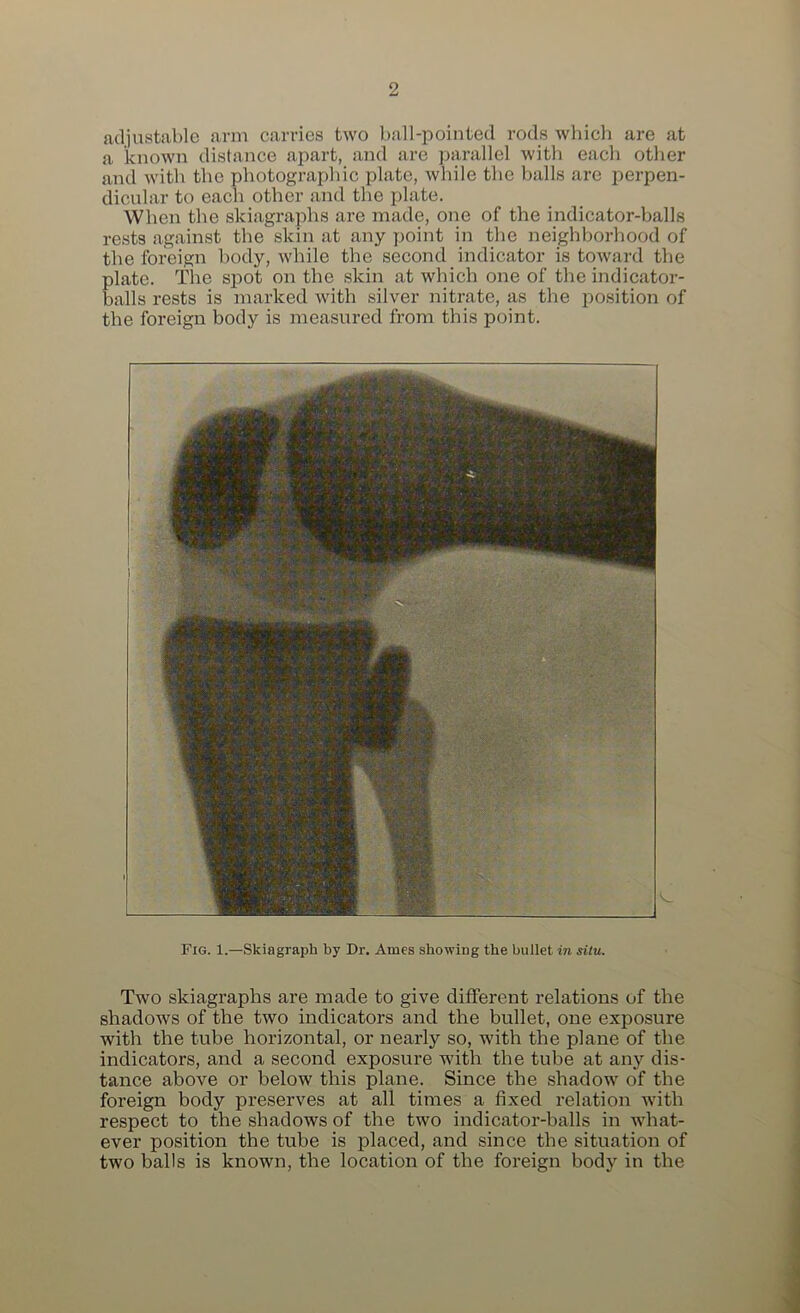 adiustable arm carries two ball-pointed rods which are at a known distance apart, and are parallel with each other and with the photographic plate, while the balls are perpen- dicular to each other and the plate. When the skiagraphs are made, one of the indicator-balls rests against the skin at any point in the neighborhood of the foreign body, while the second indicator is toward the plate. The spot on the skin at which one of the indicator- balls rests is marked with silver nitrate, as the position of the foreign body is measured from this point. Fig. 1.—Skiagraph by Dr. Ames showing the bullet in situ. Two skiagraphs are made to give different relations of the shadows of the two indicators and the bullet, one exposure with the tube horizontal, or nearly so, with the plane of the indicators, and a second exposure with the tube at any dis- tance above or below this plane. Since the shadow of the foreign body preserves at all times a fixed relation with respect to the shadows of the two indicator-balls in what- ever position the tube is placed, and since the situation of two balls is known, the location of the foreign body in the