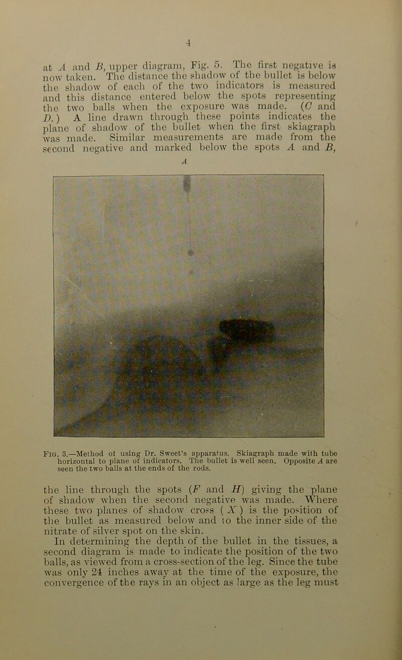 at A and Ji, upper diagram, Fig. 5. The lirst negative is now taken. The distance the shadow of the bullet is below the sliadow of each of the two indicators is measured and this distance entered below the spots repre.senting the two balls when the exposure was made. (C and D.) A line drawn through these points indicates the plane of shadow of the bullet when the first skiagraph was made. Similar measurements are made from tne second negative and marked below the spots A and B, A Fig. 3.—Method ot using Dr. Sweet’s apparatus. Skiagraph made with tube horizontal to plane of indicators. The bullet is well seen. Opposite A are seen the two balls at the ends of the rods. the line through the spots (F and H) giving the plane of shadow tvhen the second negative was made. Where these two lolanes of shadow cross ( W) is the position of the bullet as measured below and to the inner side of the nitrate of .silver spot on the skin. In determining the depth of the bullet in the tissues, a second diagram is made to indicate the position of the two balls, as viewed from a cross-section of the leg. Since the tube was only 24 inches away at the time of the exposure, the convergence of the rays in an object as large as the leg must