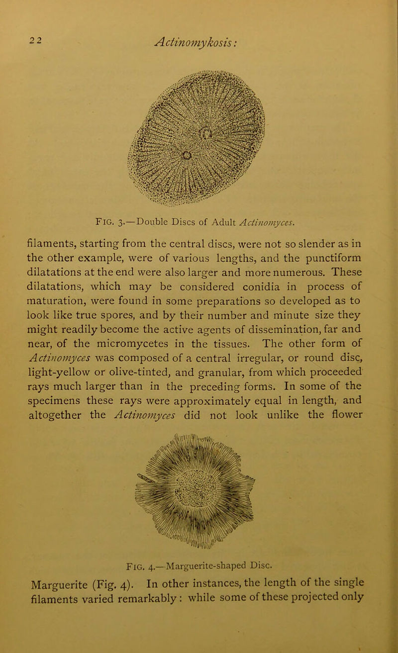 Fig. 3. — Double Discs of Adult Actinomyces. filaments, starting from the central discs, were not so slender as in the other example, were of various lengths, and the punctiform dilatations at the end were also larger and more numerous. These dilatations, which may be considered conidia in process of maturation, were found in some preparations so developed as to look like true spores, and by their number and minute size they might readily become the active agents of dissemination, far and near, of the micromycetes in the tissues. The other form of Actinomyces was composed of a central irregular, or round disc, light-yellow or olive-tinted, and granular, from which proceeded rays much larger than in the preceding forms. In some of the specimens these rays were approximately equal in length, and altogether the Actinomyces did not look unlike the flower Fig. 4.—Marguerite-shaped Disc. Marguerite (Fig. 4). In other instances, the length of the single filaments varied remarkably : while some of these projected only