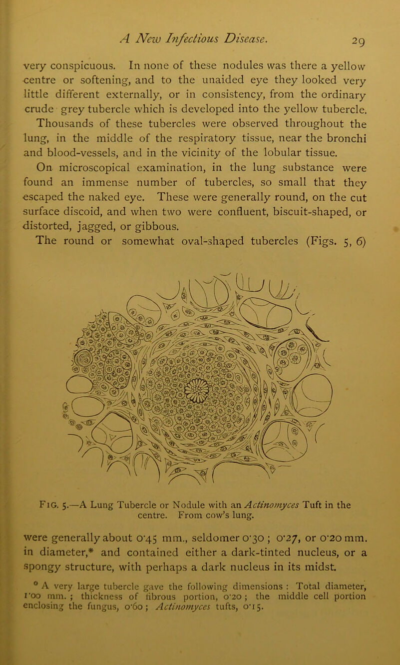 very conspicuous. In none of these nodules was there a yellow centre or softening, and to the unaided eye they looked very little different externally, or in consistency, from the ordinary crude grey tubercle which is developed into the yellow tubercle. Thousands of these tubercles were observed throughout the lung, in the middle of the respiratory tissue, near the bronchi and blood-vessels, and in the vicinity of the lobular tissue. On microscopical examination, in the lung substance were found an immense number of tubercles, so small that they escaped the naked eye. These were generally round, on the cut surface discoid, and when two were confluent, biscuit-shaped, or distorted, jagged, or gibbous. The round or somewhat oval-shaped tubercles (Figs. 5, 6) Fig. 5.—A Lung Tubercle or Nodule with an Actinomyces Tuft in the centre. From cow’s lung. were generally about 04.5 mm., seldomer o’30 ; o‘27, or 0’2omm. in diameter,* and contained either a dark-tinted nucleus, or a spongy structure, with perhaps a dark nucleus in its midst. 0 A very large tubercle gave the following dimensions : Total diameter, I'oo mm. ; thickness of fibrous portion, o-20 ; the middle cell portion enclosing the fungus, o-6o; Actinomyces tufts, on 5.