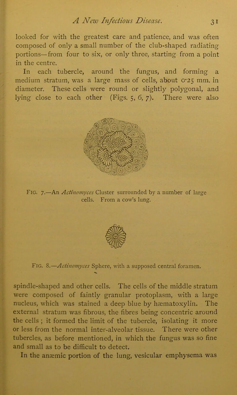 looked for with the greatest care and patience, and was often composed of only a small number of the club-shaped radiating portions—from four to six, or only three, starting from a point in the centre. In each tubercle, around the fungus, and forming a medium stratum, was a large mass of cells, about 0-25 mm. in diameter. These cells were round or slightly polygonal, and lying close to each other (Figs. 5, 6, 7). There were also Fig. 7.—An Actinomyces Cluster surrounded by a number of large cells. From a cow’s lung. Fig. 8.—Actinomyces Sphere, with a supposed central foramen. spindle-shaped and other cells. The cells of the middle stratum were composed of faintly granular protoplasm, with a large nucleus, which ivas stained a deep blue by haematoxylin. The external stratum was fibrous, the fibres being concentric around the cells ; it formed the limit of the tubercle, isolating it more or less from the normal inter-alveolar tissue. There were other tubercles, as before mentioned, in which the fungus was so fine and small as to be difficult to detect. In the anaemic portion of the lung, vesicular emphysema was