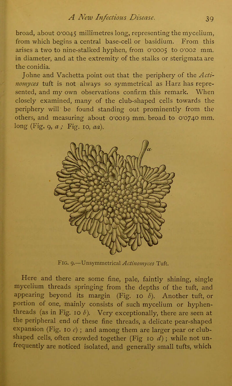 broad, about 0*0045 millimetres long, representing the mycelium, from which begins a central base-cell or basidium. From this arises a two to nine-stalked hyphen, from 0*0005 to 0*002 mm. in diameter, and at the extremity of the stalks or sterigmata are the conidia. Johne and Vachetta point out that the periphery of the Acti- nomyces tuft is not always so symmetrical as Harz has repre- sented, and my own observations confirm this remark. When closely examined, many of the club-shaped cells towards the periphery will be found standing out prominently from the others, and measuring about 0*0019 mm. broad to 0*0740 mm. long (Fig. 9, a; Fig. 10, aa). Fig. 9.—Unsymmetrical Actinomyces Tuft. Here and there are some fine, pale, faintly shining, single mycelium threads springing from the depths of the tuft, and appearing beyond its margin (Fig. 10 b). Another tuft, or portion of one, mainly consists of such mycelium or hyphen- threads (as in Fig. 10 b). Very exceptionally, there are seen at the peripheral end of these fine threads, a delicate pear-shaped expansion (Fig. 10 c) ; and among them are larger pear or club- shaped cells, often crowded together (Fig 10 d); while not un- frequently are noticed isolated, and generally small tufts, which