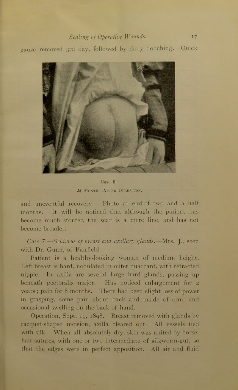 qauze removed 3rd day, followed by daily douching. Quick Case 6. 23 Months After Operation. and uneventful recovery. Photo at end of two and a half months. It will be noticed that although the patient has become much stouter, the scar is a mere line, and has not become broader. Case 7.—Schirrus of breast and axillary glands.—Mrs. [., seen with Dr. Gunn, of Fairfield. Patient is a healthy-looking woman of medium height. Left breast is hard, nodulated in outer quadrant, with retracted nipple. In axilla are several large hard glands, passing up beneath pectoralis major. Has noticed enlargement for 2 years ; pain for 8 months. There had been slight loss of power in grasping, some pain about back and inside of arm, and occasional swelling on the back of hand. Operation, Sept. 19, 1898. Breast removed with glands by racquet-shaped incision, axilla cleared out. All vessels tied with silk. When all absolutely dry, skin was united by horse- hair sutures, with one or two intermediate of silkworm-gut, so that the edges were in perfect apposition. All air and fluid