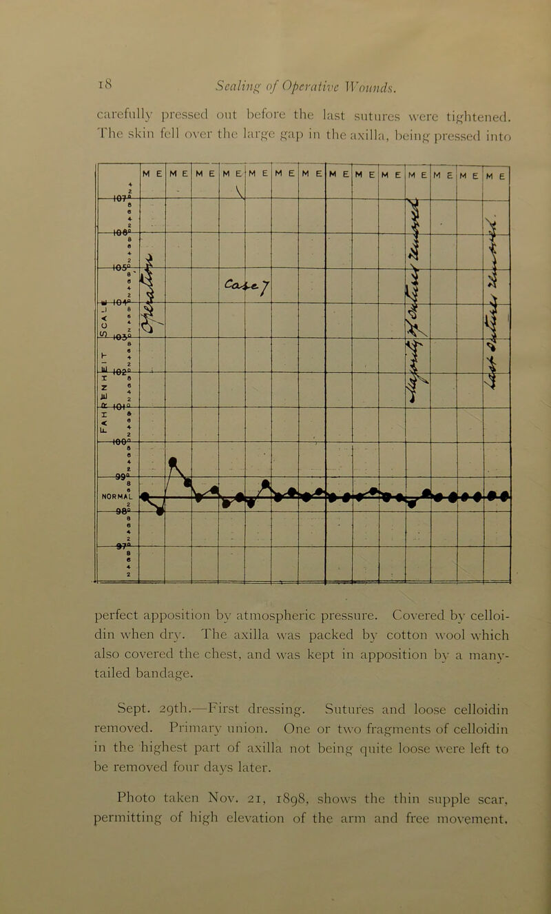 carefully pressed out before the last sutures were tightened. I he skin fell over the large gap in the axilla, being pressed into perfect apposition by atmospheric pressure. Covered by celloi- din when dry. The axilla was packed by cotton wool which also covered the chest, and was kept in apposition by a many- tailed bandage. Sept. 29th.—First dressing. Sutures and loose celloidin removed. Primary union. One or two fragments of celloidin in the highest part of axilla not being quite loose were left to be removed four days later. Photo taken Nov. 21, 1898, shows the thin supple scar, permitting of high elevation of the arm and free movement.