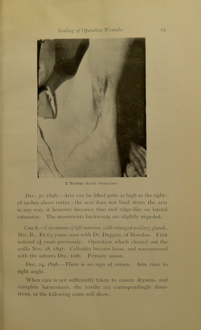 2 Months After Operation. Dec. 30, 1898.—Arm can be lifted quite as high as the right: 18 inches above vertex ; the scar does not bind down the arm in anv way, it however becomes thin and ridge-like on lateral extension. The movements backwards are slightly impeded. Case S.—Carcinoma of left mamma, with enlarged axillary glands. Mrs. B., JEt 63 years, seen with Dr. Duggan, of Bowdon. First noticed 2\ years previously. Operation which cleared out the axilla Nov. 28, 1897. Celloidin became loose, and was removed with the sutures Dec. 10th. Primary union. Dec. 24, 1898.—There is no sign of return. Arm rises to right angle. When care is not sufficiently taken to ensure dryness, and complete haemostasis, the results are correspondingly disas- trous, as the following cases will show.