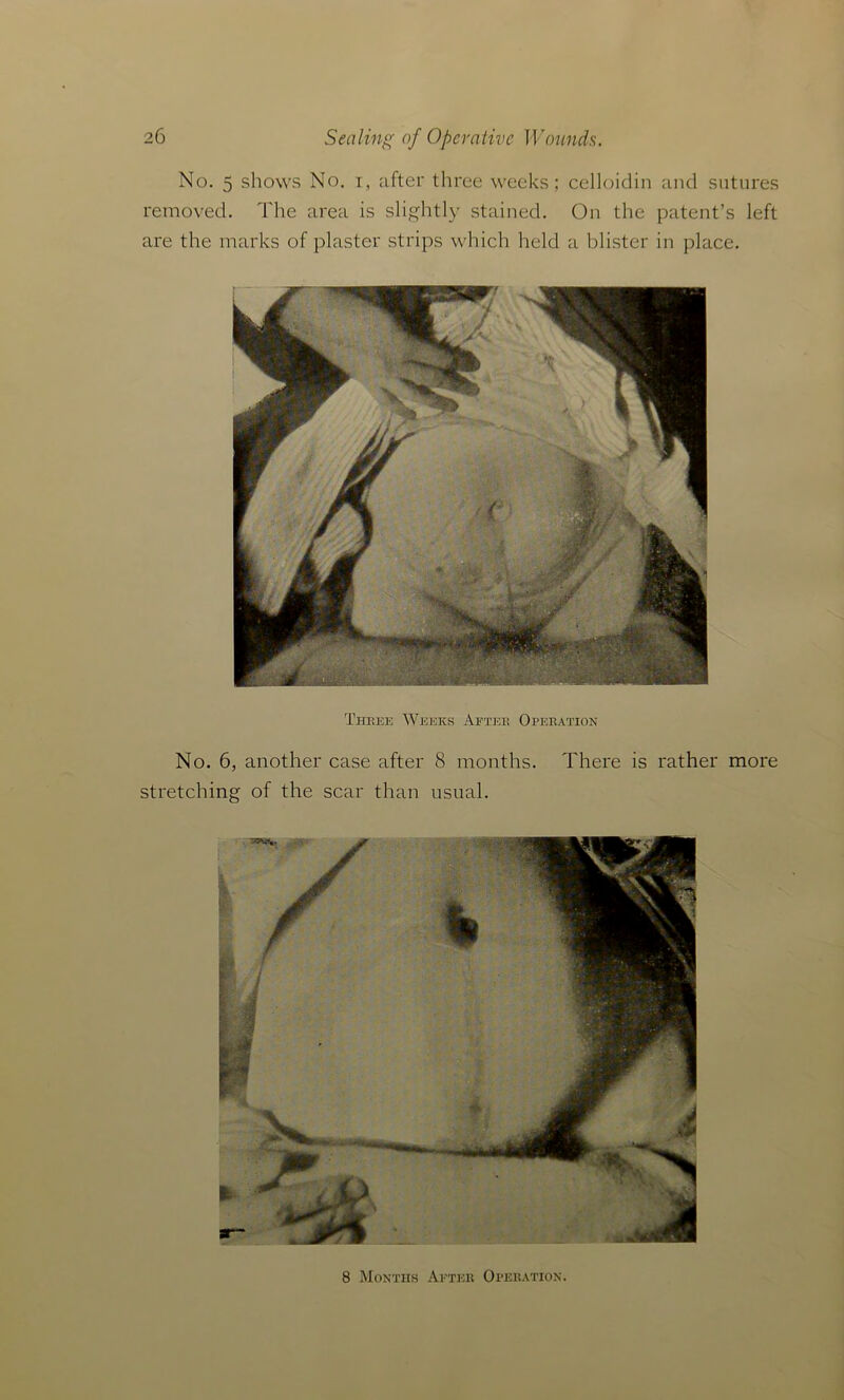 No. 5 shows No. i, after three weeks; celloidin and sutures removed. The area is slightly stained. On the patent’s left are the marks of plaster strips which held a blister in place. Three Weeks After Operation No. 6, another case after 8 months. There is rather more stretching of the scar than usual.