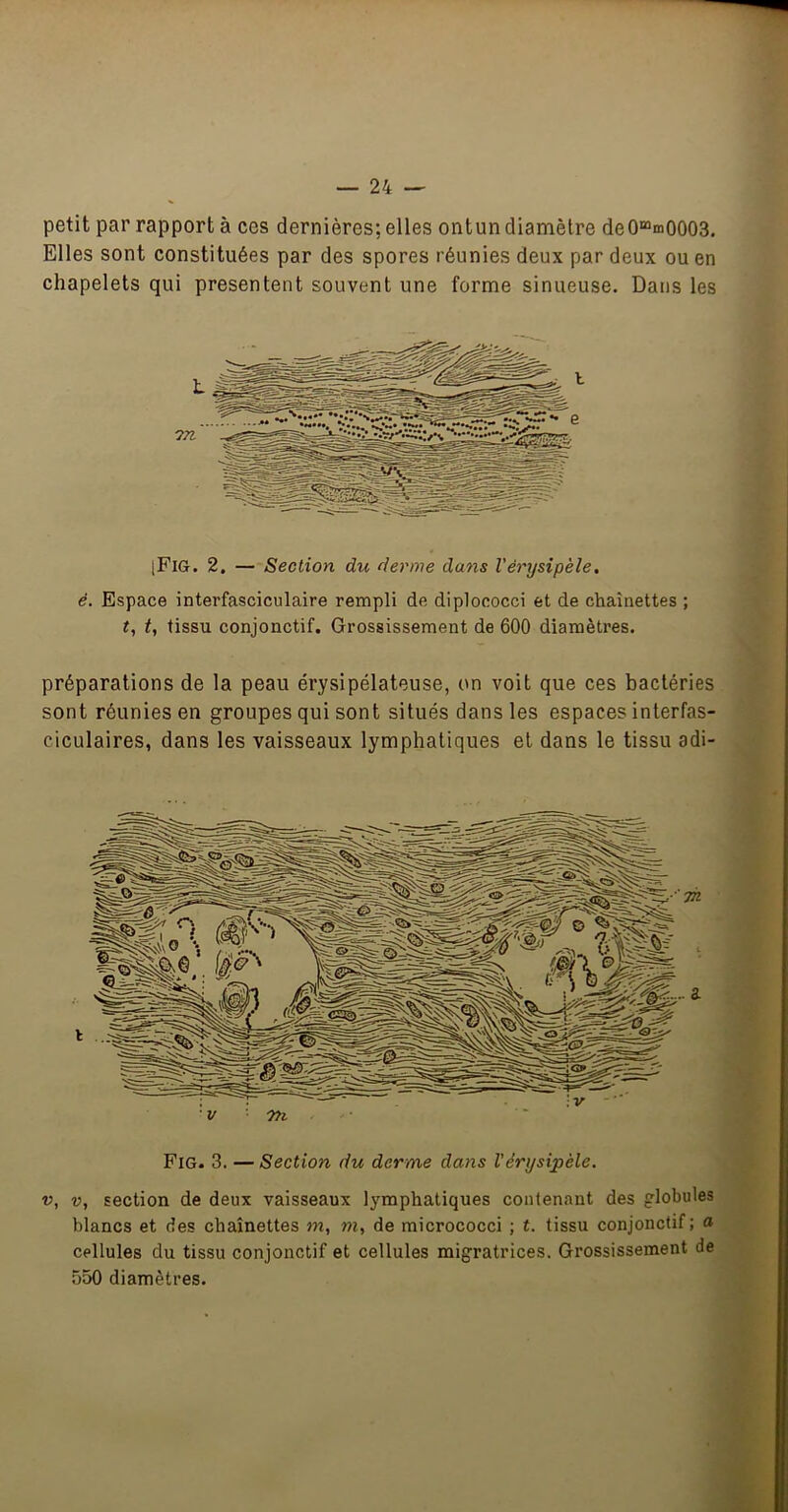 petit par rapport à ces dernières; elles ontun diamètre de0“m0003. Elles sont constituées par des spores réunies deux par deux ou en chapelets qui présentent souvent une forme sinueuse. Dans les [Fig. 2. — Section du derme dans Vérysipèle. é. Espace interfasciculaire rempli de diplococci et de chaînettes ; t, tissu conjonctif. Grossissement de 600 diamètres. préparations de la peau érysipélateuse, on voit que ces bactéries sont réunies en groupes qui sont situés dans les espaces interfas- ciculaires, dans les vaisseaux lymphatiques et dans le tissu adi- Fig. 3. — Section du derme dans Vérysipèle. V, V, section de deux vaisseaux lymphatiques contenant des globules blancs et des chaînettes m, m, de micrococci ; t. tissu conjonctif; a cellules du tissu conjonctif et cellules migratrices. Grossissement de 550 diamètres.