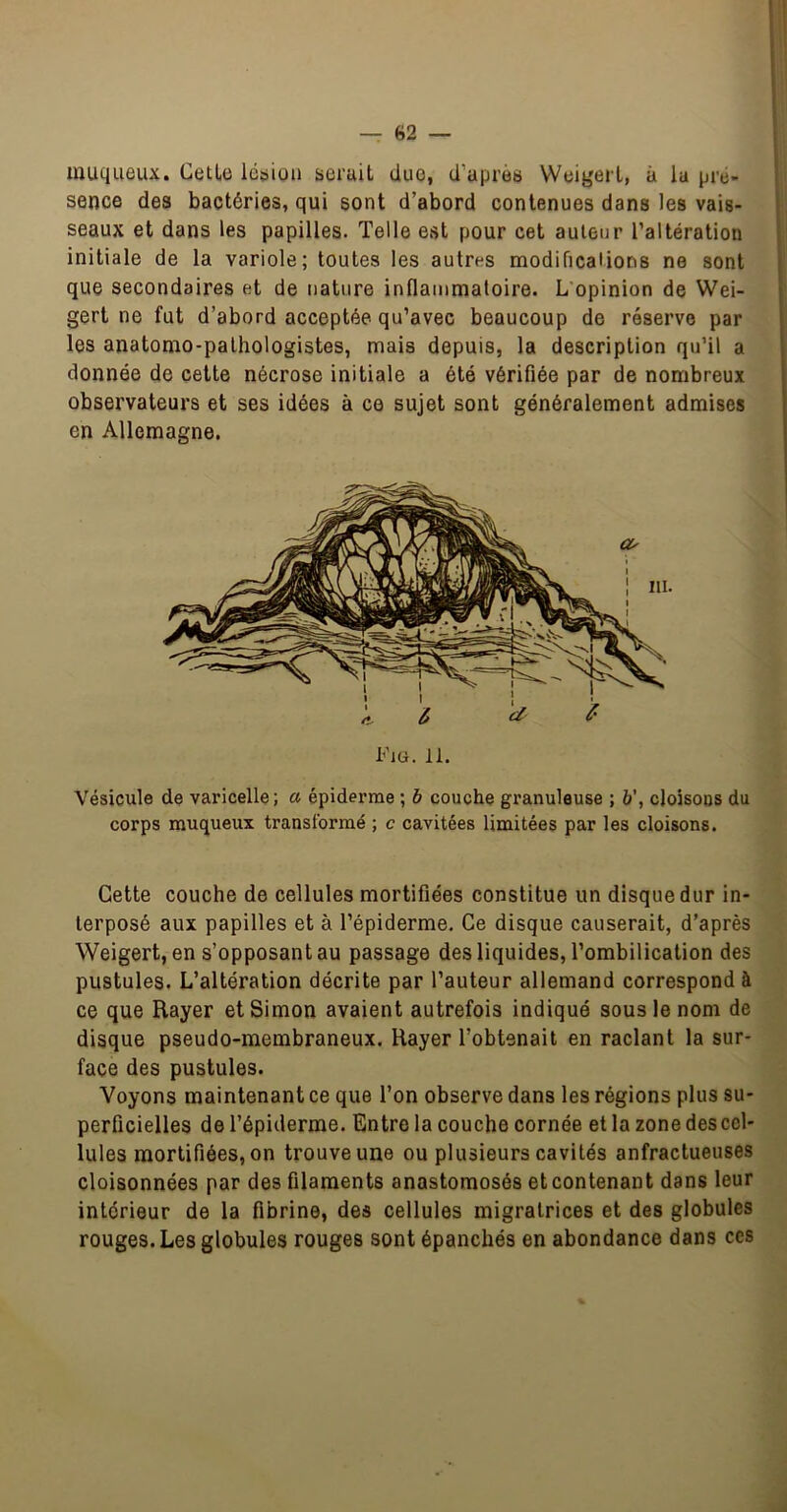 muqueux. CetLe lésion serait duo, d’après Weigerl, à la pré- sence des bactéries, qui sont d’abord contenues dans les vais- seaux et dans les papilles. Telle est pour cet auteur l’altération initiale de la variole; toutes les autres modifications ne sont que secondaires et de nature inflammatoire. L’opinion de Wei- gert ne fut d’abord acceptée qu’avec beaucoup de réserve par les anatomo-pathologistes, mais depuis, la description qu’il a donnée de cette nécrose initiale a été vérifiée par de nombreux observateurs et ses idées à ce sujet sont généralement admises en Allemagne. Fig. 11. Vésicule de varicelle; a épiderme ; h couche granuleuse ; 6’, cloisons du corps muqueux transformé ; c cavitées limitées par les cloisons. Cette couche de cellules mortifiées constitue un disque dur in- terposé aux papilles et à l’épiderme. Ce disque causerait, d’après Weigert, en s’opposant au passage des liquides, l’ombilication des pustules. L’altération décrite par l’auteur allemand correspond à ce que Rayer et Simon avaient autrefois indiqué sous le nom de disque pseudo-membraneux. Rayer l’obtenait en raclant la sur- face des pustules. Voyons maintenant ce que l’on observe dans les régions plus su- perficielles de l’épiderme. Entre la couche cornée et la zone des cel- lules mortifiées, on trouve une ou plusieurs cavités anfractueuses cloisonnées par des filaments anastomosés et contenant dans leur intérieur de la fibrine, des cellules migratrices et des globules rouges. Les globules rouges sont épanchés en abondance dans ces