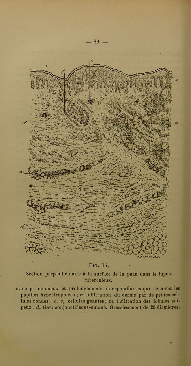 Fig. 15. Section perpendiculaire à la surface de la peau dans tuberculeux. le lupus e, corps muqueux et prolongements interpapillaires qui séparent les papilles hypertrophiées ; n, infiltration du derme par de pet tes cel- lules rondes; c, c, cellules géantes; m, infiltration des lobules adi- peux; d, tifsu conjonctif sous-cutané. Grossissement de 20 diamètres.