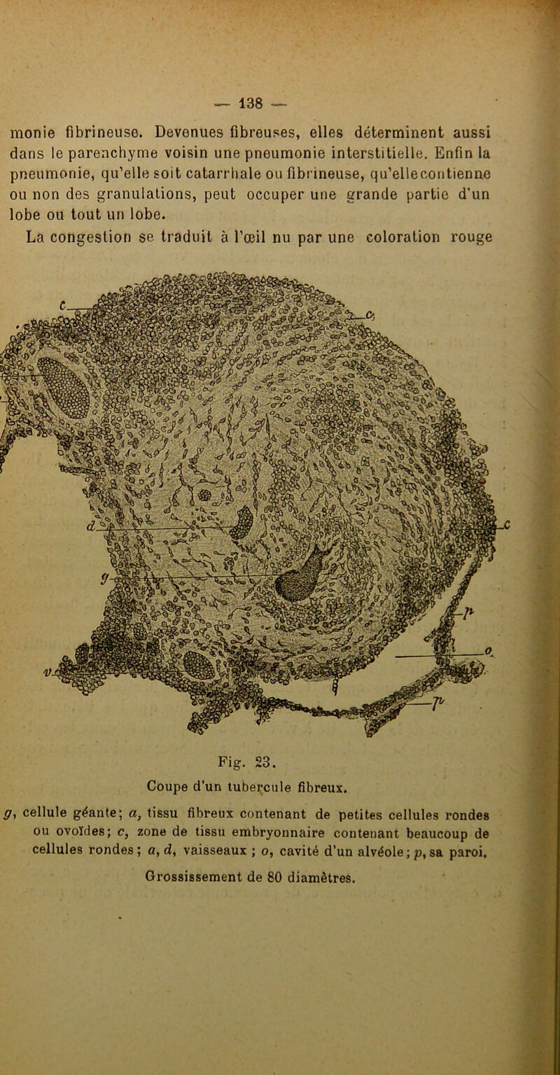 monie fibrineuse. Devenues fibreuses, elles déterminent aussi dans le parenchyme voisin une pneumonie interstitielle. Enfin la pneumonie, qu’elle soit catarrhale ou fibrineuse, qu’ellecontienne ou non des granulations, peut occuper une grande partie d’un lobe ou tout un lobe. La congestion se traduit à l’œil nu par une coloration rouge Fig. 23. Coupe d’un tubercule fibreux. cellule géante; a, tissu fibreux contenant de petites cellules rondes ou ovoïdes; c, zone de tissu embryonnaire contenant beaucoup de cellules rondes; a, d, vaisseaux ; o, cavité d’un alvéole;p,sa paroi. Grossissement de 80 diamètres.