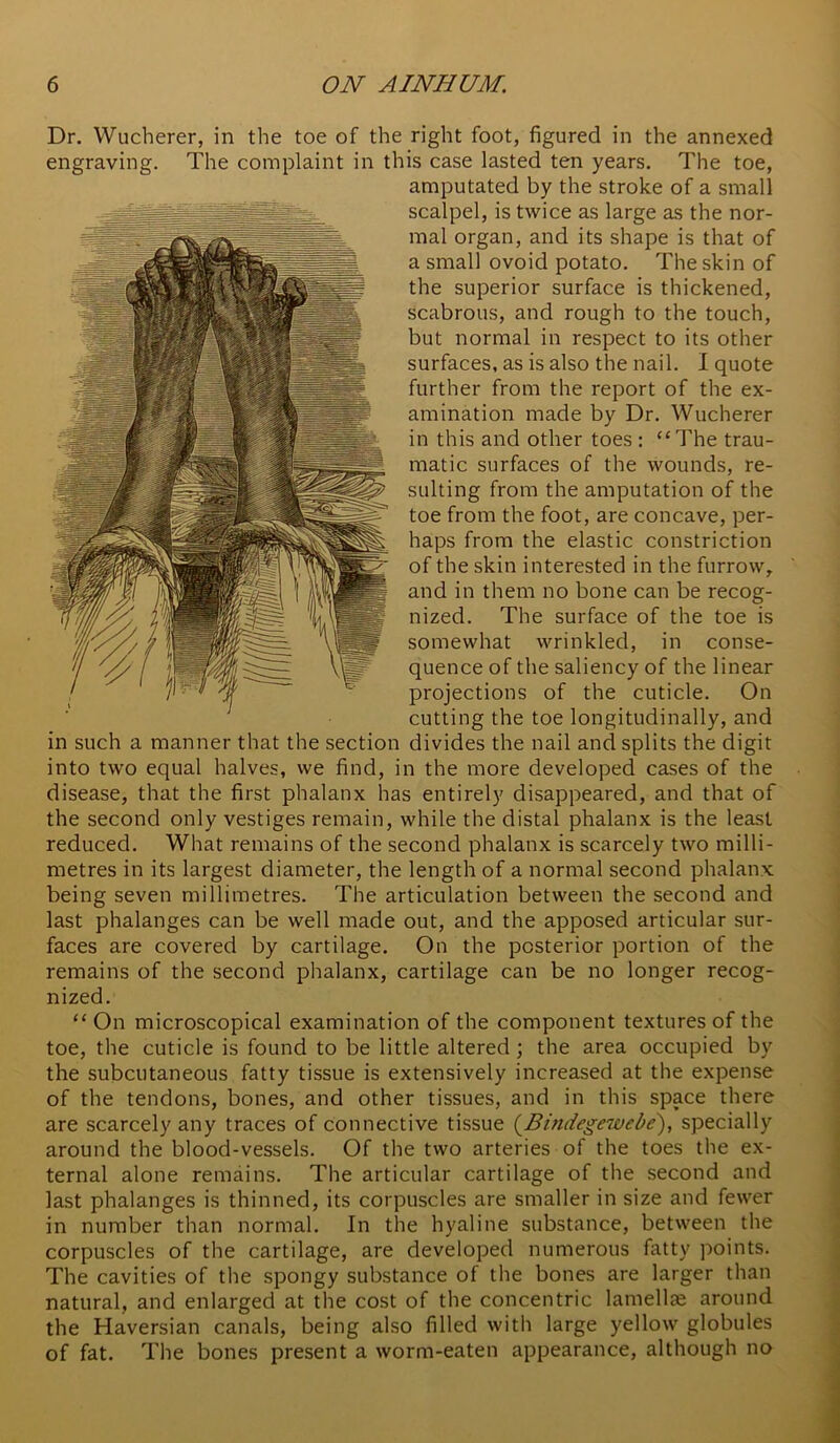 Dr. Wucherer, in the toe of the right foot, figured in the annexed engraving. The complaint in this case lasted ten years. The toe, amputated by the stroke of a small scalpel, is twice as large as the nor- mal organ, and its shape is that of a small ovoid potato. The skin of the superior surface is thickened, scabrous, and rough to the touch, but normal in respect to its other surfaces, as is also the nail. 1 quote further from the report of the ex- amination made by Dr. Wucherer in this and other toes: “The trau- matic surfaces of the wounds, re- sulting from the amputation of the toe from the foot, are concave, per- haps from the elastic constriction of the skin interested in the furrow, and in them no bone can be recog- nized. The surface of the toe is somewhat wrinkled, in conse- quence of the saliency of the linear projections of the cuticle. On cutting the toe longitudinally, and in such a manner that the section divides the nail and splits the digit into two equal halves, we find, in the more developed cases of the disease, that the first phalanx has entirely disappeared, and that of the second only vestiges remain, while the distal phalanx is the least reduced. What remains of the second phalanx is scarcely two milli- metres in its largest diameter, the length of a normal second phalanx being seven millimetres. The articulation between the second and last phalanges can be well made out, and the apposed articular sur- faces are covered by cartilage. On the posterior portion of the remains of the second phalanx, cartilage can be no longer recog- nized. “ On microscopical examination of the component textures of the toe, the cuticle is found to be little altered; the area occupied by the subcutaneous fatty tissue is extensively increased at the expense of the tendons, bones, and other tissues, and in this space there are scarcely any traces of connective tissue (^Bindegewebe), specially around the blood-vessels. Of the two arteries of the toes the ex- ternal alone remains. The articular cartilage of the second and last phalanges is thinned, its corpuscles are smaller in size and fewer in number than normal. In the hyaline substance, between the corpuscles of the cartilage, are developed numerous fatty points. The cavities of the spongy substance of the bones are larger than natural, and enlarged at the cost of the concentric lamellae around the Haversian canals, being also filled with large yellow globules of fat. The bones present a worm-eaten appearance, although no