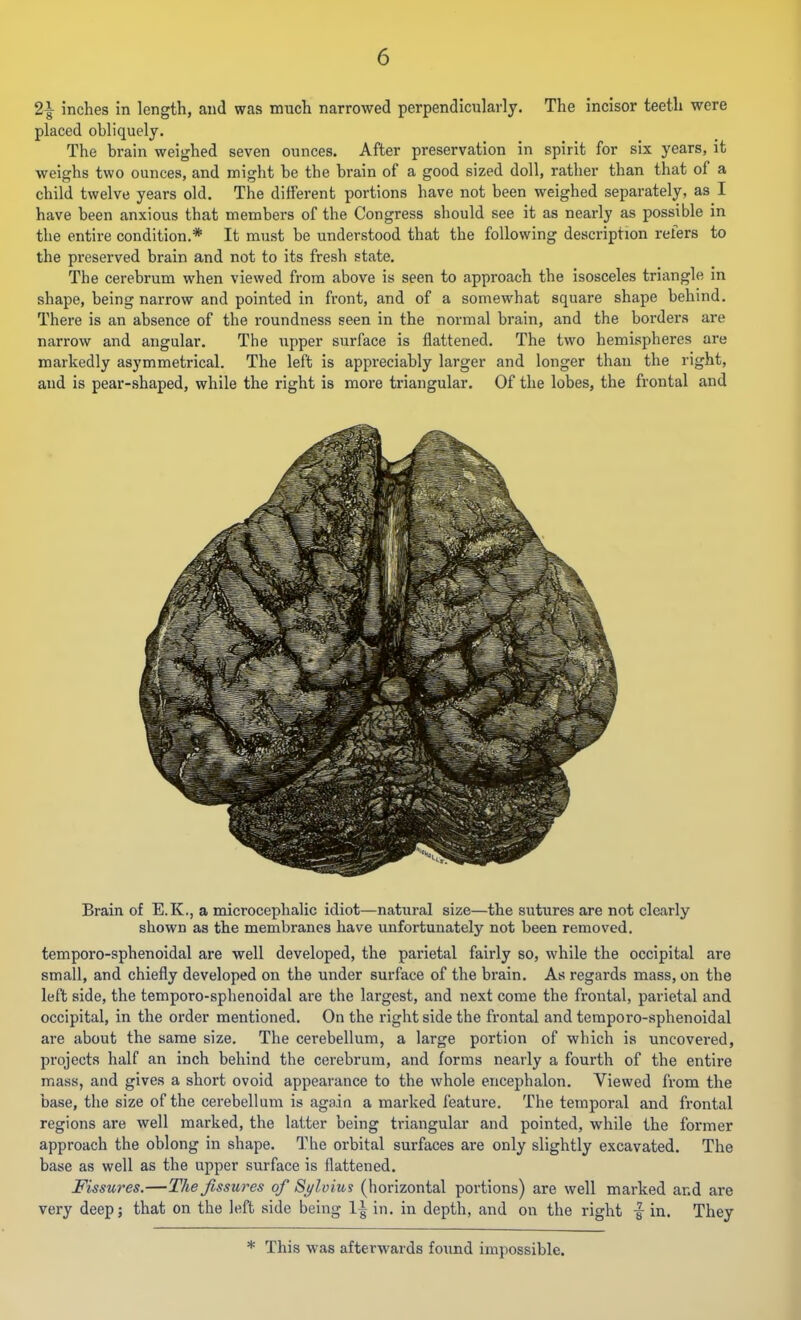 2-g- inches in length, and was much narrowed perpendicularly. The incisor teeth were placed obliquely. The brain weighed seven ounces. After preservation in spirit for six years, it weighs two ounces, and might he the brain of a good sized doll, rather than that of a child twelve years old. The different portions have not been weighed separately, as I have been anxious that members of the Congress should see it as neai’ly as possible in the entire condition.* It must be understood that the following description refers to the preserved brain and not to its fresh state. The cerebrum when viewed from above is seen to approach the isosceles triangle in shape, being narrow and pointed in front, and of a somewhat square shape behind. There is an absence of the I’oundness seen in the normal brain, and the borders are narrow and angular. Tbe upper surface is flattened. The two hemispheres are markedly asymmetrical. The left is appreciably larger and longer than the right, and is pear-shaped, while the right is more triangular. Of the lobes, the frontal and Brain of E.K., a microcephalic idiot—natural size—the sutures are not clearly shown as the membranes have unfortunately not been removed. temporo-sphenoidal are well developed, the parietal fairly so, while the occipital are small, and chiefly developed on the under surface of the brain. As regards mass, on the left side, the temporo-sphenoidal are the largest, and next come the frontal, parietal and occipital, in the order mentioned. On the right side the frontal and temporo-sphenoidal are about the same size. The cerebellum, a large portion of which is uncovered, projects half an inch behind the cerebrum, and forms nearly a fourth of the entire mass, and gives a short ovoid appearance to the whole encephalon. Viewed from the base, the size of the cerebellum is again a marked feature. The temporal and frontal regions are well marked, the latter being triangular and pointed, while the former approach the oblong in shape. The orbital surfaces are only slightly excavated. The base as well as the upper surface is flattened. Fissures.—The fissures of Sj/lvius (horizontal portions) are well marked and are very deep; that on the left side being in. in depth, and on the right ■§■ in. They * This was afterwards found impossible.