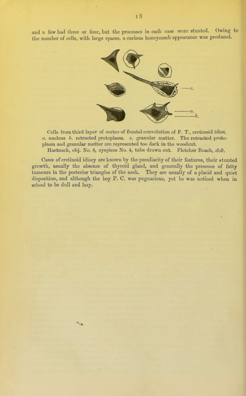 and a few had Uirec or four, hut the processes in each case were stunted. Owing to the number of cells, with large spaces, a curious honeycomb appearance was produced. c. a. —b. Cells from third layer of cortex of frontal convolution of F. T., cretinoid idiot. a. nucleus b. retracted protoplasm, c. granular matter. The retracted proto- l^lasm aud granular matter are represented too dark in the woodcut. Hartnack, obj. No. 8, eyepiece No. 4, tube drawn out. Fletcher Beach, ddt. Cases of cretinoid idiocy are known by the peculiarity of their features, their stunted growth, usually the absence of thyroid gland, and generally the presence of fatty tumours in the posterior triangles of the neck. They are usuallj' of a placid and quiet disposition, and although the boy P. C. was pugnacious, yet he was noticed when in school to be dull and lazy.