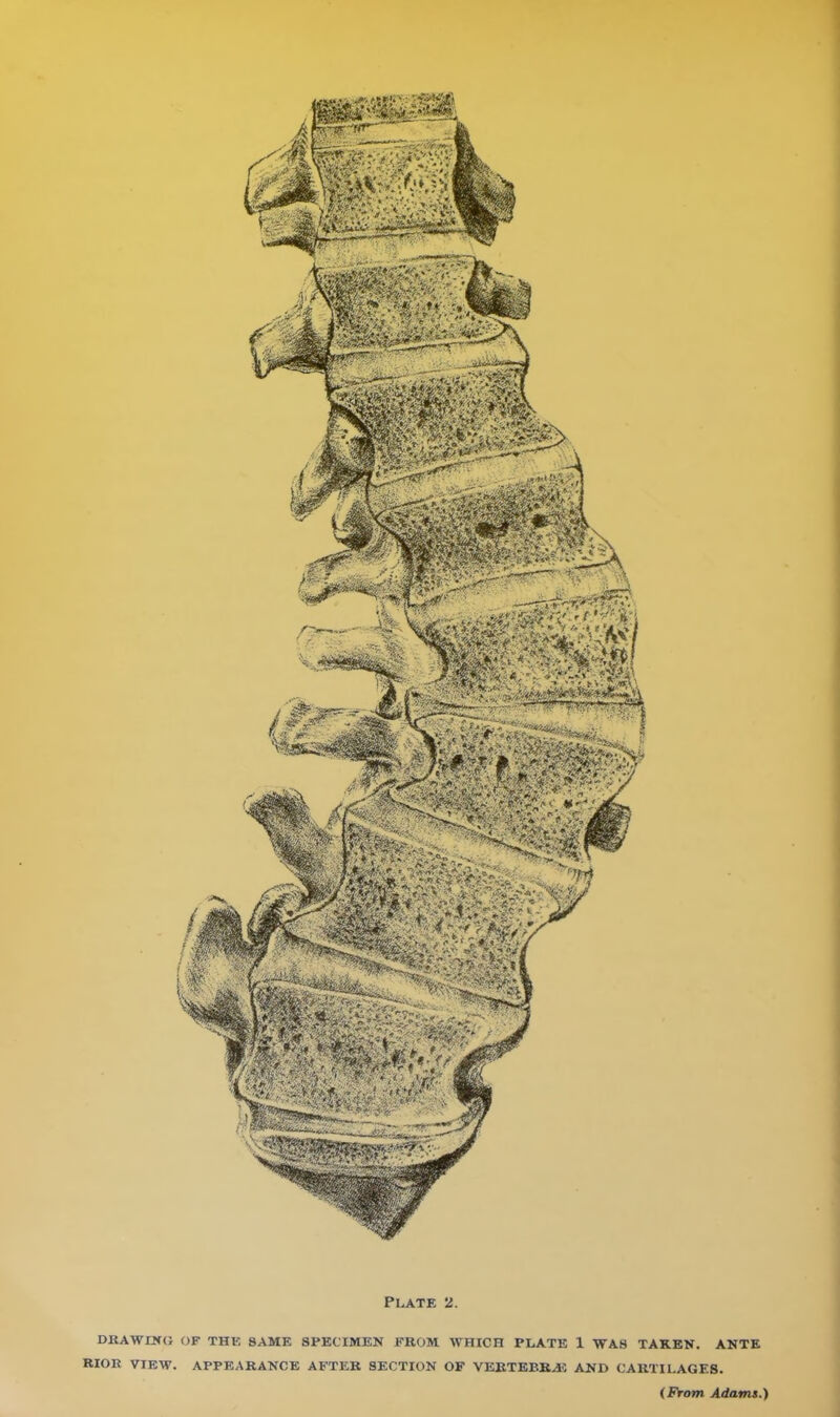 DKAWOfG OF THE SAME SPECIMEN FROM WHICH PLATE 1 WAS TAKEN. ANTE RIOR VIEW. APPEARANCE AFTER SECTION OF VERTEBRAE AND CARTILAGES. (From Adams.)