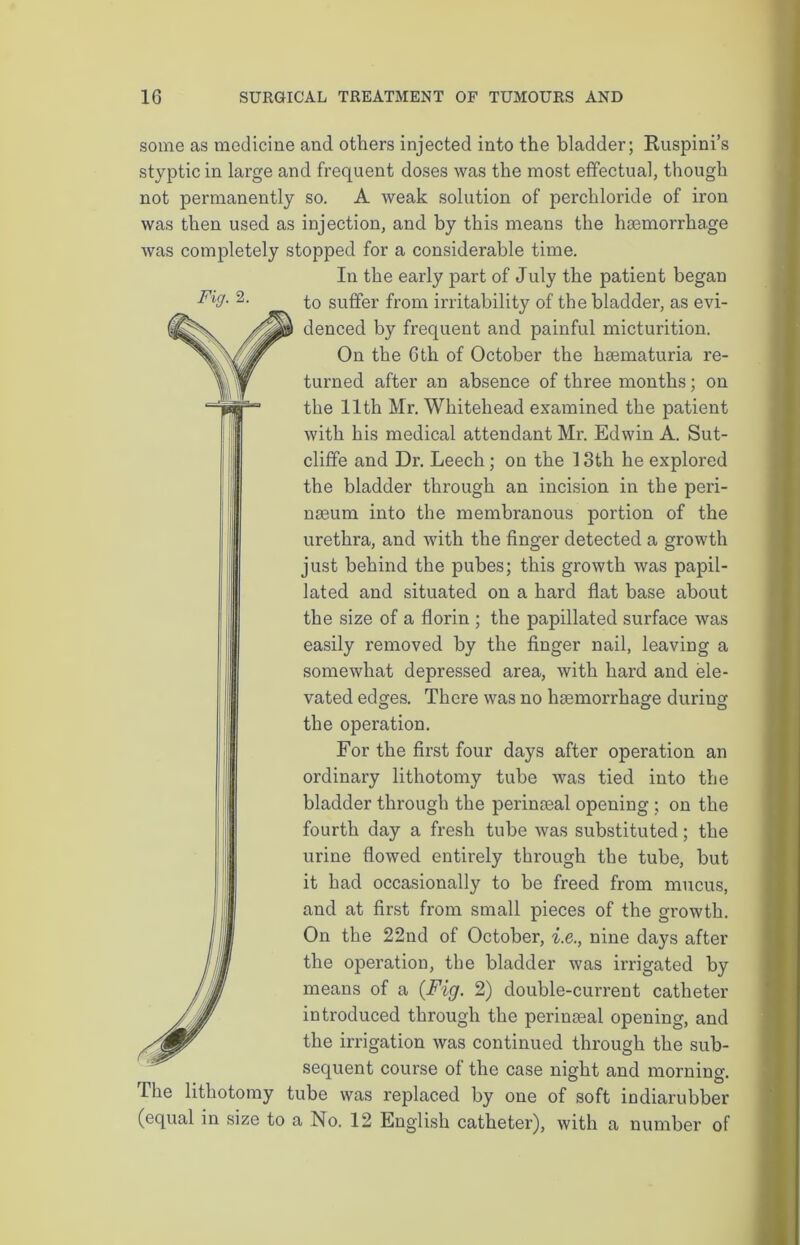 Fig. 2. some as medicine and others injected into the bladder; Ruspini’s styptic in large and frequent doses was the most effectual, though not permanently so. A weak solution of perchloride of iron was then used as injection, and by this means the haemorrhage was completely stopped for a considerable time. In the early part of July the patient began to suffer from irritability of the bladder, as evi- denced by frequent and painful micturition. On the Gth of October the haematuria re- turned after an absence of three months; on the 11th Mr. Whitehead examined the patient with his medical attendant Mr. Edwin A. Sut- cliffe and Dr. Leech; on the 13th he explored the bladder through an incision in the peri- naeum into the membranous portion of the urethra, and with the finger detected a growth just behind the pubes; this growth was papil- lated and situated on a hard flat base about the size of a florin ; the papillated surface was easily removed by the finger nail, leaving a somewhat depressed area, with hard and ele- vated edges. There was no haemorrhage during the operation. For the first four days after operation an ordinary lithotomy tube was tied into the bladder through the perinaeal opening ; on the fourth day a fresh tube was substituted; the urine flowed entirely through the tube, but it had occasionally to be freed from mucus, and at first from small pieces of the growth. On the 22nd of October, i.e., nine days after the operation, the bladder was irrigated by means of a (Fig. 2) double-current catheter introduced through the perinaeal opening, and the irrigation was continued through the sub- sequent course of the case night and morning. The lithotomy tube was replaced by one of soft indiarubber (equal in size to a No. 12 English catheter), with a number of