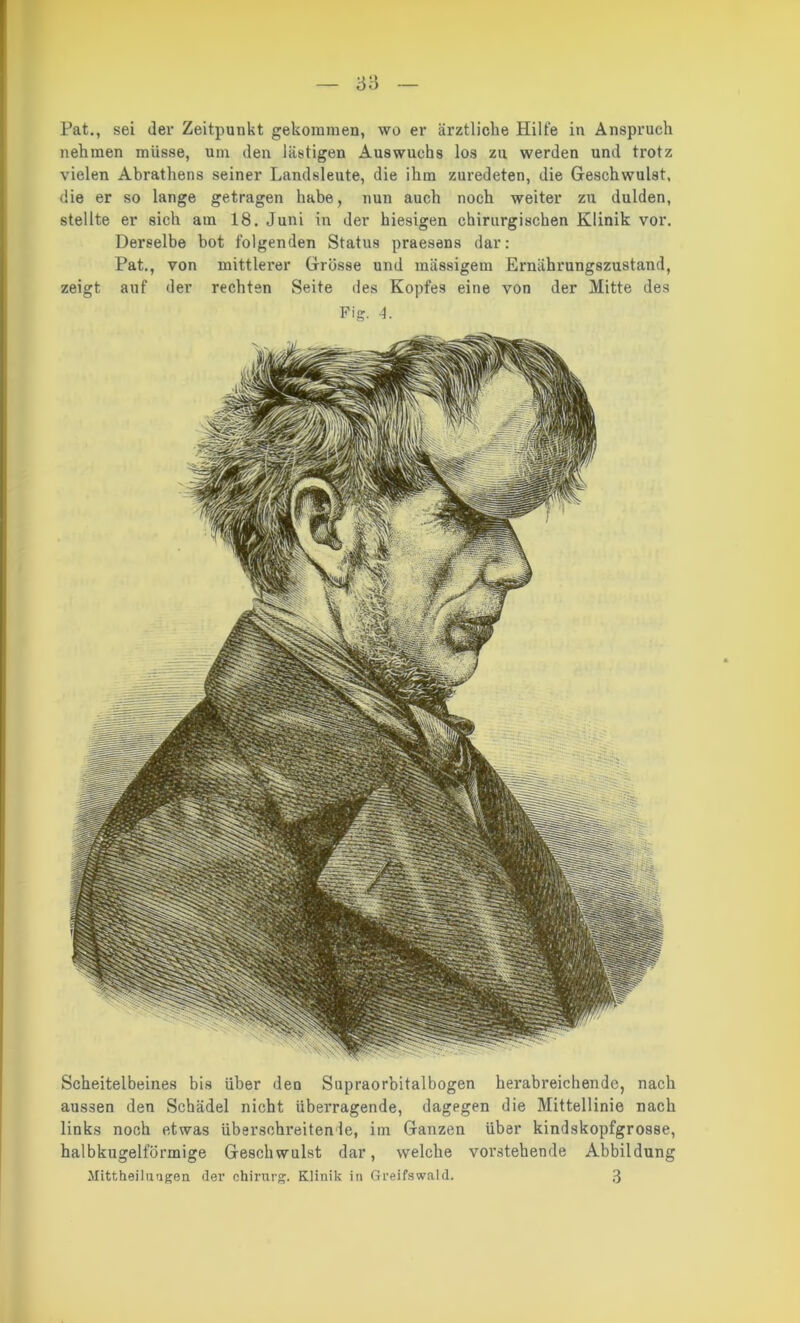 nehmen müsse, uni den lästigen Auswuchs los zu werden und trotz vielen Abrathens seiner Landsleute, die ihm zuredeten, die Geschwulst, die er so lange getragen habe, nun auch noch weiter zu dulden, stellte er sich am 18. Juni in der hiesigen chirurgischen Klinik vor. Derselbe bot folgenden Status praesens dar: Pat., von mittlerer Grösse und massigem Ernährungszustand, zeigt auf der rechten Seite des Kopfes eine von der Mitte des Fig. 4. Scheitelbeines bis über den Supraorbitalbogen herabreichende, nach aussen den Schädel nicht überragende, dagegen die Mittellinie nach links noch etwas überschreitende, im Ganzen über kindskopfgrosse, halbkugelförmige Geschwulst dar, welche vorstehende Abbildung Jtittheilungen (1er Chirurg. Klinik in Greifswald. 3