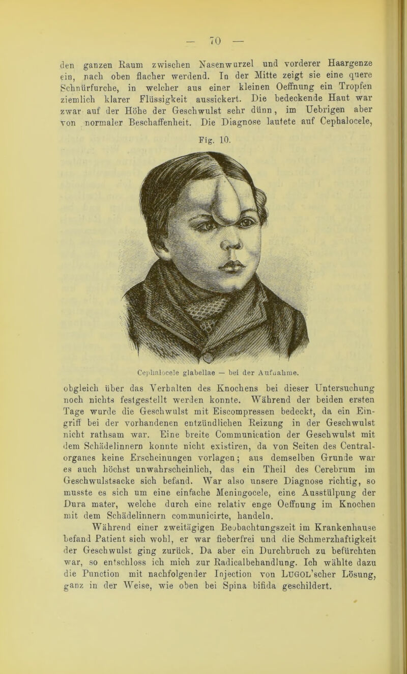 den ganzen Raum zwischen Rasenwurzel und vorderer Haargenze ein, nach oben flacher werdend. Tn der Mitte zeigt sie eine quere Sclinürfurche, in welcher aus einer kleinen Oeffnung ein Tropfen ziemlich klarer Flüssigkeit aussickert. Die bedeckende Haut war zwar auf der Höhe der Geschwulst sehr dünn , im Uebrigen aber von normaler Beschaffenheit. Die Diagnose lautete auf Cephalocele, Fig. 10. Cephalocele glabellae — bei der Aufnahme. obgleich über das Verhalten des Knochens bei dieser Untersuchung noch nichts festgestellt werden konnte. Während der beiden ersten Tage wurde die Geschwulst mit Eiscompressen bedeckt, da ein Ein- griff bei der vorhandenen entzündlichen Reizung in der Geschwulst nicht rathsam war. Eine breite Communication der Geschwulst mit dem Schädelinnern konnte nicht existiren, da von Seiten des Central- organes keine Erscheinungen Vorlagen; aus demselben Grunde war es auch höchst unwahrscheinlich, das ein Theil des Cerebrum im Geschwulstsacke sich befand. War also unsere Diagnose richtig, so musste es sich um eine einfache Meningocele, eine Ausstülpung der Dura mater, welche durch eine relativ enge Oeffnung im Knochen mit dem Schädelinnern communicirte, handeln. Während einer zweitägigen Beubachtungszeit im Krankenhause befand Patient sich wohl, er war fieberfrei und die Schmerzhaftigkeit der Geschwulst ging zurück. Da aber ein Durchbruch zu befürchten war, so entschloss ich mich zur Radicalbehandlung. Ich wählte dazu die Function mit nachfolgender Injection von LuGOL’scher Lösung, ganz in der Weise, wie oben bei Spina bifida geschildert.