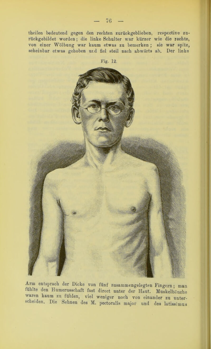 theilen bedeutend gegen den rechten zurückgeblieben, respective za- rückgebildet worden; die linke Schulter war kürzer wie die rechte, von einer Wölbung war kaum etwas zu bemerken ; sie war spitz, scheinbar etwas gehoben ur.d fiel steil nach abwärts ab. Der linke Fig. 12. Arm entsprach der Dicke von fünf zusammengelegten Fingern; man fühlte den Humerusschaft fast direct unter der Haut. Muskelbäuche waren kaum zu fühlen, viel weniger noch von einander zu unter- scheiden. Die Sehnen des M. pectoralis major und des latissimus