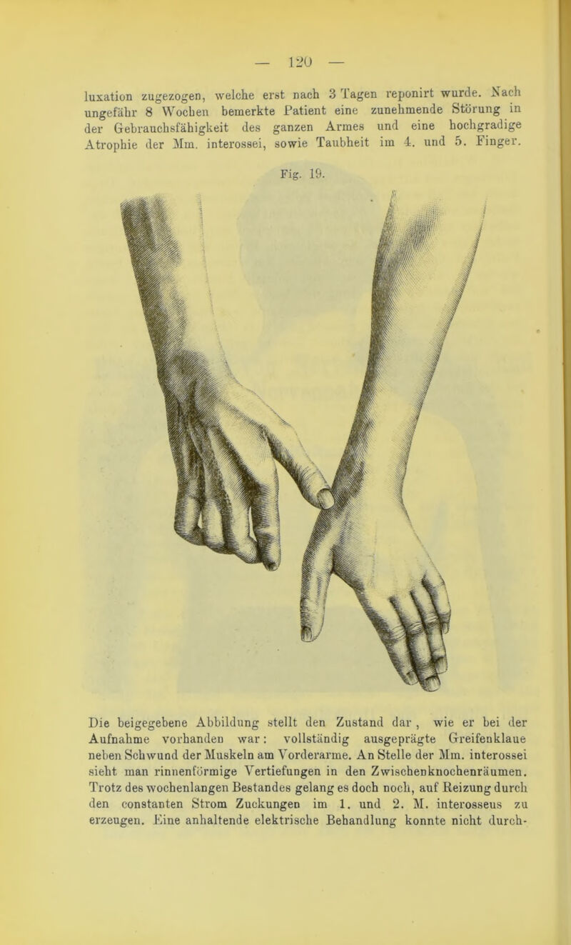 luxation zugezogen, welche erst nach 3 'lagen veponirt wurde, R ach ungefähr 8 Woeben bemerkte Patient eine zunehmende Störung in der Gebrauchsfähigkeit des ganzen Armes und eine hochgradige Atrophie der Mm. interossei, sowie Taubheit im 4. und 5. Finger. Fig. 19. Die beigegebene Abbildung stellt den Zustand dar , wie er bei der Aufnahme vorhanden war: vollständig ausgeprägte Greifenklaue neben Schwund der Muskeln am Vorderarme. An Stelle der Mm. interossei sieht man rinnenförmige Vertiefungen in den Zwischenkuochenräumen. Trotz des wochenlangen Bestandes gelang es doch noch, auf Reizung durch den constanten Strom Zuckungen im 1. und 2. M. interosseus zu erzeugen. Fine anhaltende elektrische Behandlung konnte nicht durch-