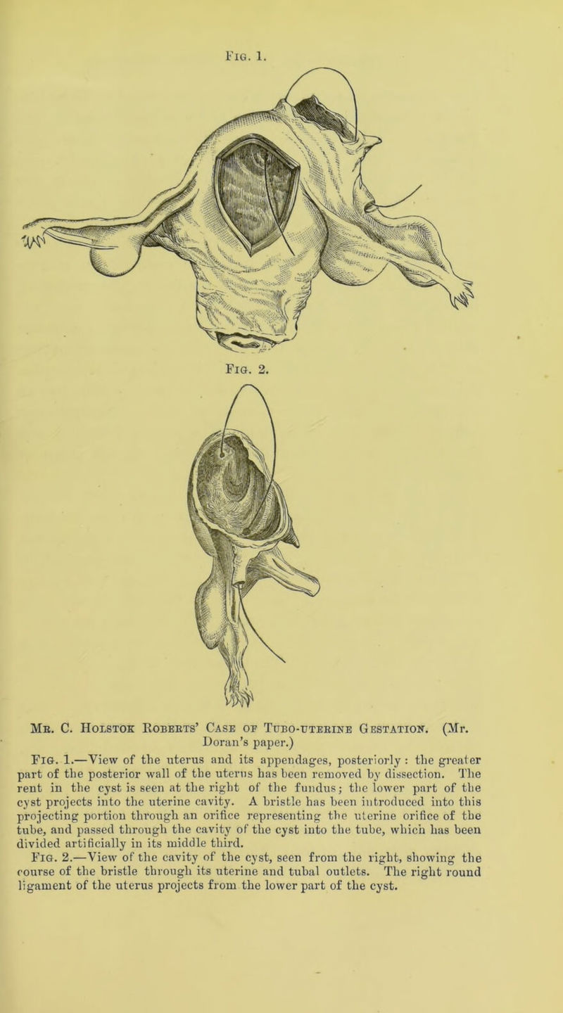 Fig. 1. Me. C. Holstok Kobeets’ Case oe Ttjbo-bteeine Gestation. (Mr. Doran’s paper.) Fig. 1.—View of the uterus and its appendages, posteriorly : the greater part of the posterior wall of the uterus has been removed by dissection. The rent in the cyst is seen at the right of the fundus; the lower part of the cyst projects into the uterine cavity. A bristle has been introduced into this projecting portion through an orifice representing the uterine orifice of the tube, and passed through the cavity of the cyst into the tube, which has been divided artificially in its middle third. Fig. 2.—View of the cavity of the cyst, seen from the right, showing the course of the bristle through its uterine and tubal outlets. The right round ligament of the uterus projects from the lower part of the cyst.