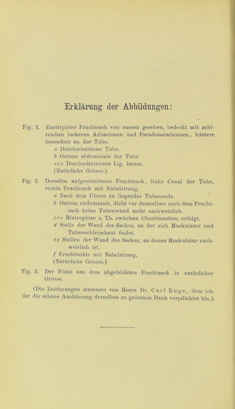 Erklärung der Abbildungen: Fig. 1. Exstirpirter Fruchtsack von aussen gesehen, bedeckt mit zahl- reichen lockeren Adhäsionen und Pseudomembranen, letztere besonders an der Tube. « Durchschnittene Tube. b Ostium abdominale der Tube. ccc Durchschnittenes Lig. latum. (Natürliche Grösse.) Fig. 2. Derselbe aufgeschnittene Fruchtsack, links Canal der Tube, rechts Fruchtsack mit Nabelstrang. « Nach dem Uterus zu liegendes Tubenende. b Ostium abdominale, dicht vor demselben nach dem Frucht- sack keine Tubenwand mehr nachweislich. ccc Blutergüsse z. Th. zwischen Chorionzotten erfolgt. d Stelle der Wand des Sackes, an der sich Muskulatur und Tubenschleimhaut findet. ce Stellen der Wand des Sackes, an denen Muskulatur nach- weislich ist. f Fruchthöhle mit Nabelstrang. (Natürliche Grösse.) Fig. 3. Der Fötus aus dem abgebildeten Fruchtsack in natürlicher Grösse. (Die Zeichnungen stammen von Herrn Dr. Carl Rüge, dem icli für die schöne Ausführung derselben zu grösstem Dank verpflichtet bin.)