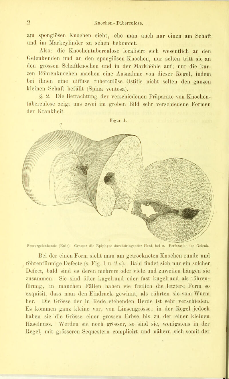 am spongiösen Knochen sieht, ehe man auch nur einen am Schaft und im Markcylinder zu sehen bekommt. Also: die Knochentuberculose localisirt sich wesentlich an den Gelenkenden und au den S])ongiöscn Knochen, nur selten tritt sie an den grossen Schaftknochen und in der iMarkhöhle auf; nur die kur- zen Röhrenknochen machen eine Ausnahme von dieser Regel, indem hei ihnen eine dilfusc tuberculöse Ostitis nicht selten den ganzen kleinen Schaft befällt (Spina ventosa). 2. Die Betrachtung der verschiedenen Präparate von Knochen- tuberculose zeigt uns zwei im groben Bild sehr verschiedene Formen der Krankheit. Figur 1. Feinurgclcnkendc (Knie). Grosser die Epiphyse dtircliciriiigeiidcr Herd, bei a. Perforation ins Gelenk. Bei der einen Form sieht man am getrockneten Knochen runde und röhrenförmige Dcfecte (s. Fig. 1 u. 2 a). Bald findet sich nur ein solcher Defect, bald sind es deren mehrere oder viele und zuweilen hängen sic zusammen. Sie sind öfter kugelrund oder fast kugelrund als röhren- förmig, in manchen Fällen haben sie freilich die letztere Form so exfpusit, dass man den Eindruck gewinnt, als rührten sic vom Wurm her. Die Grösse der in Rede stehenden Herde ist sehr vcrscliieden. Es kommen ganz kleine vor, von Linseugrösse, in der Regel jedoch haben sic die Grösse einer grossen Erbse bis zu der einer kleinen Haselnuss. Werden sie noch grösser, so sind sie, wenigstens in der Regel, mit grösseren Sequestern complicirt und nähern sich somit der