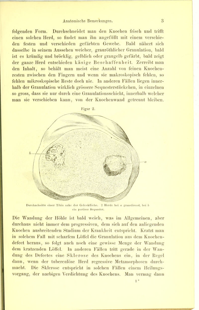 folgenden Form. Durcbschneidet man den Knochen frisch und trifi’t einen solchen Herd, so findet man ihn angefüllt mit einem verschie- den festen und verschieden gefärbten Gewebe. Bald nähert sich dasselbe in seinem Aussehen weicher, grauröthlicher Granulation, bald ist es krümlig und bröcklig, gelblich oder graugell) gefärbt, bald zeigt der ganze Herd entschieden käsige Beschaffenheit. Zerreibt man den Inhalt, so behält man meist eine Anzahl von feinen Knochen- resten zwischen den Fingern und wenn sie makroskopisch fehlen, so fehlen mikroskopische Reste doch nie. In anderen Fällen liegen inner- halb der Granulation wirklich grössere Sequesterstückchen, in einzelnen so gross, dass sie nur durch eine Granulationsschicht, innerhalh welcher man sie verschieben kann, von der Knochenwand getrennt bleiben. Figur 2. Durchsclinittc einer Tibia nahe der GelenktUiclie. 2 Herde bei a grannlirend, bei b ein poröser Sequester. Die Wandung der Höhle i.st bald weich, was im Allgemeinen, aber durchaus nicht immer dem ])rogressiven, dem sich auf den aidicgenden Knochen aushreitenden Stadium der Krankheit entspricht. Kratzt man in solchem Fall mit scharfem Löffel die Granulation aus dem Knochen- defect heraus, so folgt auch noch eine gewisse iVIcnge der AVanduiig dem kratzenden Löffel, ln anderen Fällen tritt gerade in der AAhin- dung des Defectes eine Sklerose des Knochens ein, in der Kegel dann, wenn der tnherculösc Herd regressive Metamorphosen durch- macht. Die Sklerose ents])richt in solchen Fällen einem Heilungs- vorgang, der narbigen Verdichtung des Knochens. Man vermag dann 1 *