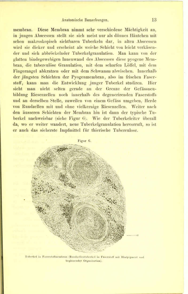 membran. Diese Membran nimmt sehr verscbietlene Mächtigkeit an, in jungen Abscessen stellt sie sich meist nur als dünnes }läutchen mit schon makroskopisch sichtbaren Tuberkeln dar, in alten Abscessen wird sie dicker und erscheint als weiche Schicht von leicht verkäsen- der und sich abbröckelnder Tuberkelgrauulation. Man kann von der glatten bindegewebigen Innenwand des Abscesses diese pyogene Mem- bran, die tuberculöse Granulation, mit dem scharfen Löffel, mit dem Fingernagel abkratzen oder mit dem Schwamm abw'ischen. Innerhalb der jüngsten Schichten der Pyogenmembran, also im frischen Faser- stoff, kann man die Entwicklung .junger Tuberkel studiren. Hier sieht man nicht selten gerade an der Grenze der Gefässneu- bildung Riesenzellen noch innerhalb des degenerirenden Faserstoffs und an derselben Stelle, zuweilen von einem Gefäss umgeben, Herde von Rundzellen mit und ohne vielkernige Riesenzellen. Weiter nach den äusseren Schichten der Membran hin ist dann der typische Tu- berkel nachweisbar (siehe Figur 6). Wie der Tuberkeleiter überall da, wo er weiter wandert, neue Tuberkelgranulation hervorruft, so ist er auch das sicherste Impfmittel für thierische Tuberculöse. Figur 6. Tubfrkel in Faserston'inejnbran (Uundzollentnborkcl in Faserstoff mit Hlutpigmont tnul beginnender Organisation).