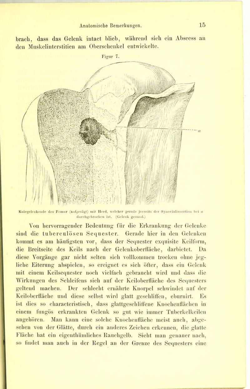 brach, dass das Gelenk intact blieb, während sieb ein Abscess an den IMiiskelinterstitien am Oberschenkel entwickelte. Figur 7. Kiiicgelonkende des Femur (auf^^esiigt) mit Herd, welcher gerade jenseits der i^ynovialinsertion hoi ci durchgebroclicn ist. (Gelenk gesund.) Von hervorragender Bedeutung für die Erkrankung der Gelenke sind die tuberculösen Se(iuester. Gerade hier in den Gelenken kommt es am häutigsten vor, dass der Seciuester exijuisite Kcilform, die Breitseite des Keils nach der Gelenkobertläclie, darbictet. Da diese Vorgänge gar nicht selten sich vollkommen trocken ohne jeg- liche Eiterung absi)ielen, so ereignet es sich öfter, dass ein Gelenk mit einem Keilse((uester noch vielfach gebraucht wird und dass die Wirkungen des Sehleifens sich auf der Keilobertläche des Se(iuesters geltend machen. Der schlecht ernälirte Knorpel schwindet auf der Keilobertläche und diese selbst wird glatt geschliffen, eburuirt. Es ist dies so characteristisch, dass glattgeschlilfene Knocheuflächcn in einem fungös erkrankten Gelenk so gut wie immer Tul)erkelkeileu angehören. Mau kann eine solche Knochcutläche meist auch, abge- sehen von der Glätte, durch ein anderes Zeichen erkennen, die glatte Elächc hat ein eigenthiimliches Rauchgelb. Siebt man genauer nach, so findet man auch in der Regel an der Grenze des Seiiuesters eine