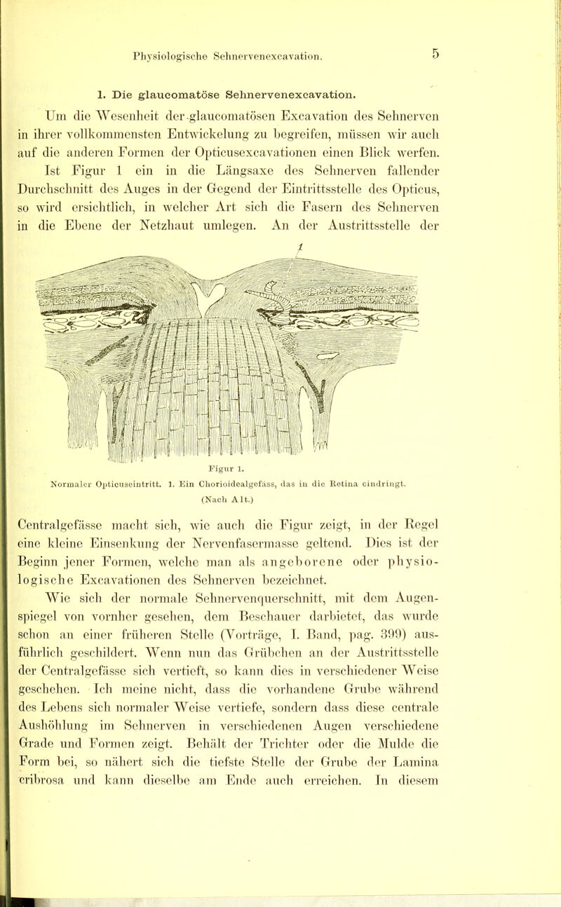 1. Die glaucomatöse Sehnervenexeavation. Um die Wesenlieit der glaucomatösen Excavatioii des Sehnerven in ihrer vollkoinmensten Entwickelung zu begreifen, müssen wir aucli auf die anderen Formen der Opticusexcavationen einen Blick werfen. Ist Figur 1 ein in die Längsaxe des Sehnerven fallender Durchschnitt des Auges in der Gegend der Eintrittsstelle des Opticus, so wird ersichtlich, in welcher Art sich die Fasern des Sehnerven in die Ebene der Netzhaut undegen. An der Austrittsstelle der Figur 1. Normaler Opticuseintritt, 1. Ein Cliorioidcalgefäss, das iu die llotina eindringt. (Nach Alt.) Centralgefässe macht sich, wie auch die Figur zeigt, in der Regel eine kleine Einsenlvung der Nervenfasermasse geltend. Dies ist der Beginn jener Eormen, welche man als angeborene oder physio- logische Excavationen des Sehnerven bezeichnet. Wie sieh der noi'male Sehnervenquerschnitt, mit dem Augen- spiegel von vornher gesehen, dem Beschauer darbietot, das wurde schon an einer früheren Stelle (Vorti’cäge, 1. Band, j^ag. 3b9) aus- fühi'lich geschildert. Wenn nun das Grübchen an der Austrittsstelle der Centralgefässe sich vertieft, so kann dies in verschiedener Weise geschehen. Ich meine nicht, dass die vorhandene Grube während des Lebens sich normaler Weise vertiefe, sondern dass diese centrale Aushöhlung im Sehnerven in verschiedenen Augen verschiedene Grade und Eor'men zeigt. Behält der Trichter oder die Mulde die Form bei, so nähert sich die tiefste Stelle der Grube der Lamina cribrosa und kann dieselbe am Endo auch erreichen. In diesem I I