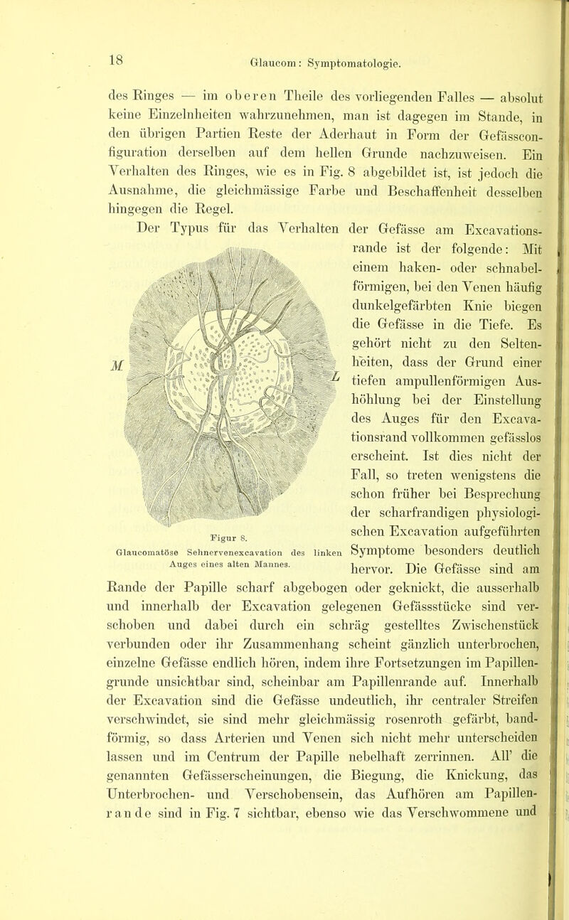 des Ringes — im oberen Theile des vorliegenden Falles — absolut keine Einzelnlieiten walirzuuebmen, man ist dagegen im Stande, in den übrigen Partien Reste der Aderhaut in Form der Gefässcon- figuration derselben auf dem hellen Grunde nachzuweisen. Ein Verhalten des Ringes, wie es in Fig. 8 abgebildet ist, ist jedoch die Ausnahme, die gleichmässige Farbe und Beschaffenheit desselben hingegen die Regel. Der Typus für das Verhalten der Gefässe am Excavations- rande ist der folgende: Mit einem haken- oder schnabel- förmigen, bei den Venen häufig] dunkelgefärbten Knie biegen f die Gefässe in die Tiefe. Es gehört nicht zu den Selten- heiten, dass der Grund einer, tiefen ampullenförmigen Aus- höhlung bei der Einstellung des Auges für den Excava tionsrand vollkommen gefässlos erscheint. Ist dies nicht der Fall, so treten wenigstens die schon früher bei Besprechung der scharfrandigen physiologi- „ sehen Excavation aufgeführten Figur 8. ® Glancoinatöse Sehnervenexcavation des linken SyiHptoIllG bGSOndGl'S clGUtlicIl Auges eines alten Mannes. Gefässe siud am Rande der Papille scharf abgebogen oder geknickt, die ausserhalb und innerhalb der Excavation gelegenen Gefässstücke sind ver- schoben und dabei durch ein schräg gestelltes Zwischenstück verbunden oder ihr Zusammenhang scheint gänzlich unterbrochen, einzelne Gefässe endlich hören, indem ihre Fortsetzungen im Papillen- grunde unsichtbar sind, scheinbar am Papillenrande auf. Innerhalb der Excavation sind die Gefässe undeutlich, ihr centraler Streifen verschwindet, sie sind mehr gleichmässig rosenroth gefärbt, band- förmig, so dass Arterien und Venen sich nicht mehr unterscheiden lassen und im Centrum der Papille nebelhaft zerrinnen. AU’ die genannten Gefässerscheinungen, die Biegung, die Knickung, das Unterbrochen- und Verschobensein, das Aufhören am Papilleu- ran de sind in Fig. 7 sichtbar, ebenso wie das Verschwommene und