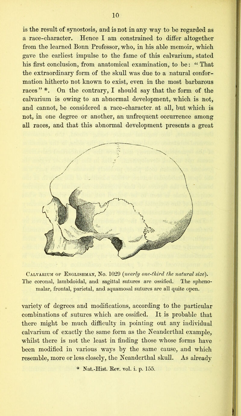 is the result of synostosis, and is not in any way to be regarded as a race-character. Hence I am constrained to differ altogether from the learned Bonn Professor, who, in his able memoir, which gave the earliest impulse to the fame of this calvarium, stated his first conclusion, from anatomical examination, to be: “ That the extraordinary form of the skull was due to a natural confor- mation hitherto not known to exist, even in the most barbarous races” *. On the contrary, I should say that the form of the calvarium is owing to an abnormal development, which is not, and cannot, be considered a race-character at all, but which is not, in one degree or another, an unfrequent occurrence among all races, and that this abnormal development presents a great Calvarium op Englishman, No. 1029 (nearly one-third the natural size). The coronal, lambdoidal, and sagittal sutures are ossified. The spheno- malar, frontal, parietal, and squamosal sutures are all quite open. variety of degrees and modifications, according to the particular combinations of sutures which are ossified. It is probable that there might be much difficulty in pointing out any individual calvarium of exactly the same form as the Neanderthal example, whilst there is not the least in finding those whose forms have been modified in various ways by the same cause, and which resemble, more or less closely, the Neanderthal skull. As already * Nat.-Hist. Rev. vol. i. p. 155.