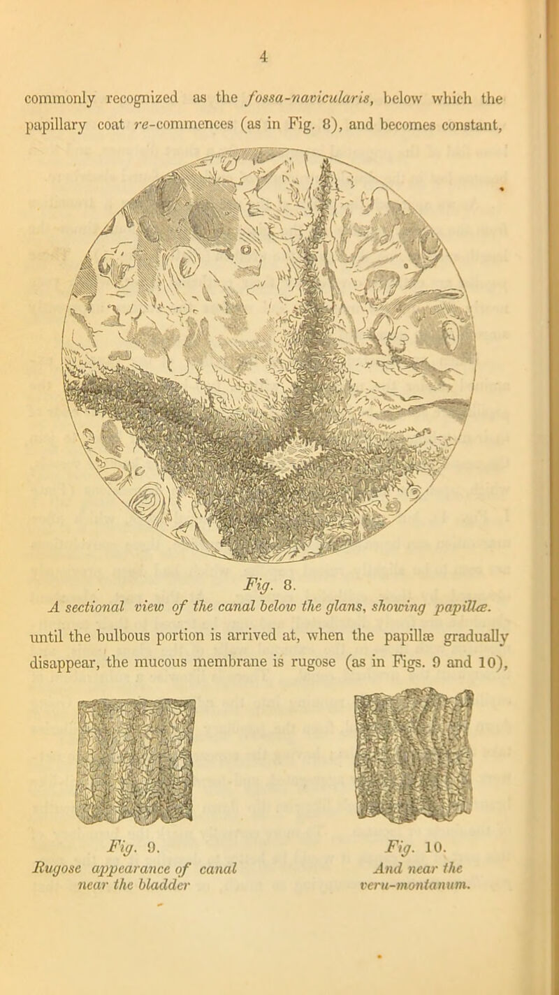 Fig. 8. A sectional view of the canal below the glans, showing papillae. until the bulbous portion is arrived at, when the papillae gradually disappear, the mucous membrane is rugose (as in Pigs. 0 and 10), commonly recognized as the fossa-navicular is, below which the papillary coat re-commcnces (as in Fig. 8), and becomes constant, Fig. 9. Rugose appearance of canal near the bladder Fig. 10. And near the veni-monianum.