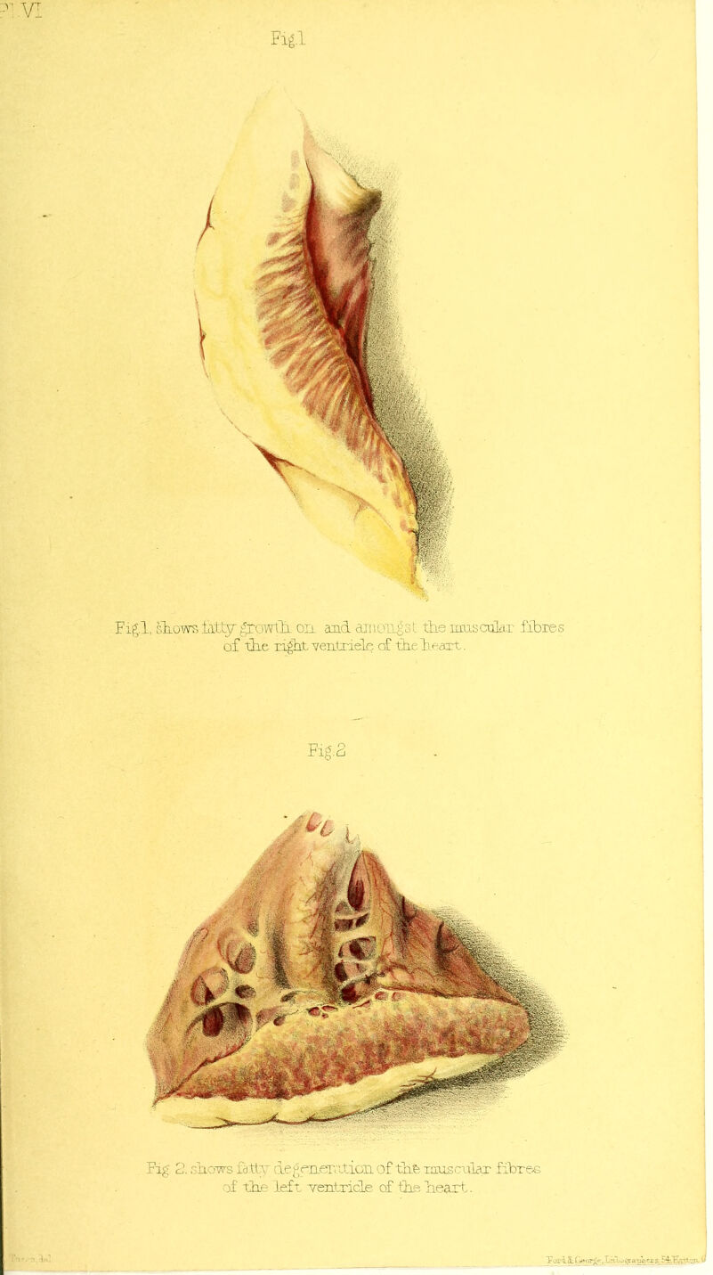 V .VI Fig.1 Fig.l, shows fatty growth on. and amongst he muscular fibres of the right, yeptriels c£ theheaxt. Fig-2 Fig. 2. shows fatly degerLer.'itioii of thfe musciiLar fibre* of the left Tentricle cf the heart. Vot-iiGeerh'. L-•fuot>ra^qers, F4.K.yt