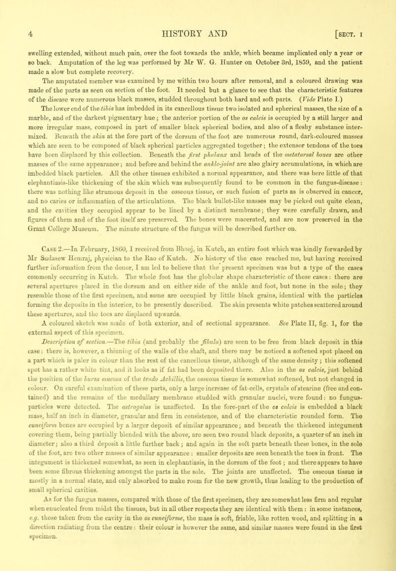 swelling extended, without much pain, over the foot towards the ankle, which became implicated only a year or BO hack. Amputation of the leg was performed by Mr W. Gr. Hunter on October 3rd, 1859, and the patient made a slow but complete recovery. The amputated member was examined by me within two hours after removal, and a coloured drawing was made of the parts as seen on section of the foot. It needed but a glance to see that the characteristic features of the disease were numerous black masses, studded throughout both hard and soft parts. {Vide Plate I.) The lower end of the^iJ/ahas imbedded in its cancellous tissue two isolated and spherical masses, the size of a marble, and of the darkest pigmentary hue ; the anterior portion of the os calcis is occupied by a still larger and more irregular mass, composed in part of smaller black spherical bodies, and also of a fleshy substance inter- mixed. Beneath the sJcin at the fore part of the dorsum of the foot are numerous round, dark-coloured masses which are seen to be composed of black spherical particles aggregated together; the extensor tendons of the toes have been displaced by this collection. Beneath the first phalanx and heads of the metatarsal bones are other masses of the same appearance; and before and behind the ankle-joint are also glairy accumulations, in which are imbedded black particles. All the other tissues exhibited a normal appearance, and there was here little of that elephantiasis-like thickening of the skin which was subsequently found to be common in the fungus-disease : there was nothing like strumous deposit in the osseous tissue, or such fusion of parts as is observed in cancer, and no caries or inflammation of the articulations. The black bullet-like masses may be picked out quite clean, and the cavities they occupied appear to be lined by a distinct membrane; they were carefully drawn, and figures of them and of the foot itself are preserved. The bones were macerated, and are now preserved in the Grant College Museum. The minute structure of the fungus will be described further on. Case 2.—In February, 18G0, I received from Bhooj, in Kutch, an entire foot which was kindly forwarded by Mr Sudasew Hemraj, physician to the llao of Kutch. No history of the case reached me, but having received further information from the donor, I am led to believe that the present specimen was but a type of the cases commonly occurring in Kutch. The whole foot has the globular shape characteristic of these cases: there are several apertures placed in the dorsum and on cither side of the ankle and foot, but none in the sole; they resemble those of the first specimen, and some are occupied by little black grains, identical with the particles forming the deposits in the interior, to be presently described. The skin presents white patches scattered around these apertures, and the toes are displaced upwards. A coloured sketch was made of both exterior, and of sectional appearance. See Plato II, fig. 1, for the external aspect of this specimen. Description of section.—The tibia (and probably the fibula) are seen to bo free from black deposit in this case: there is, however, a thinning of the walls of the shaft, and there may be noticed a softened spot placed on a part which is paler in colour than the rest of the cancellous tissue, although of the same density ; this softened spot has a rather white tint, and it looks as if fat had been deposited there. Also in the os just behind the position of the bursa mucosa of the tendo Achillis,i\\e osseous tissue is somewhat softened, hut not changed in colour. On careful examination of these parts, only a large increase of fat-cells, crystals ofstearine (free and con- tained) and the remains of the medullary membrane studded with granular nuclei, were found: no fungus- particles were detected. The astragalus is unaffected. In the fore-part of the os calcis is embedded a black mass, half an inch in diameter, granular and firm in consistence, and of the characteristic rounded form. The cuneiform bones are occupied by a larger deposit of similar appearance; and beneath the thickened integument covering them, being partially blended with the above, are seen two round black deposits, a quarter of an inch in diameter; also a third deposit a little further back ; and again in the soft parts beneath these bones, in the sole of the foot, are two other masses of similar appearance : smaller deposits are seen beneath the toes in front. The integument is thickened somewhat, as seen in elephantiasis, in the dorsum of the foot; and there appears to have been some fibrous thickening amongst the parts in the sole. The joints are unaffected. The osseous tissue is mostly in a normal state, and only absorbed to make room for the new growth, thus leading to the production of small spherical cavities. As for the fungus masses, compared with those of the first specimen, they are somewhat less firm and regular when enucleated from midst the tissues, but in all other respects they are identical with them: in some instances, e.g. those taken from the cavity in the os cuneiforme, the mass is soft, friable, like rotten wood, and splitting in a direction radiating from the centre : their colour is however the same, and similar masses were found in the first specimen.