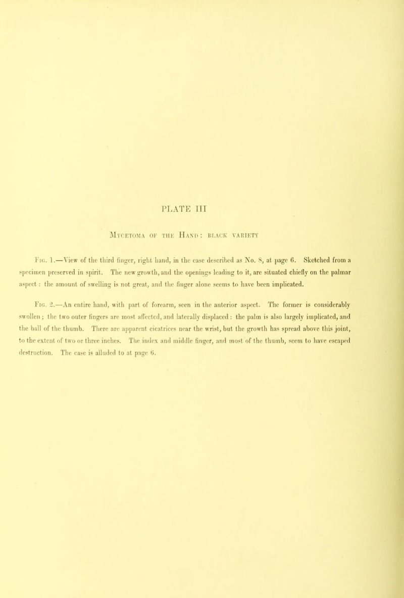 PLATE 111 Myciitoma of the IIaxd: th.ack variety Fig. 1.—View of tlie tliird finger, right hand, in the case described as No. S, at page 6. Sketched from a specimen jircserved in spirit. The new growth, and the openings leading to it, are situated chiefly on the palmar aspect : the amount of swelling is not great, and tlie finger alone .seems to have been implicated. Fig. 2.—An entire hand, with jiart of forearm, seen in the anterior aspect. The former is considerably swollen ; the two outer fingers are most affected, and laterally displaced : the jialm is also largely implicated, and the hall of the thumb. There are apparent cicatrices near the wrist, but the growth has spread above this joint, to the extent of two or three inches. The index and middle finger, and most of the thumb, seem to have escaped destruction. The case is alluded to at page b.