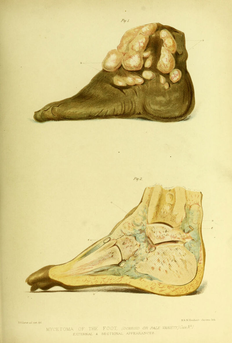 Fi^.3. e ij I •• hVCan^rad nat d«l. M.&. N.Hanhart cliromo.lith MYc:ETOMA of the foot, (ochrotd or pale vabiety.)Casejri. EXTEHMAI.. &i SECTIONAL APPEARANCES.