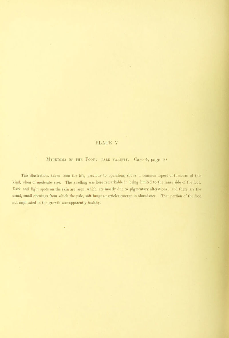 I’LATK V Mycetoma of the Foot; pale vauiety. Case 4, page 10 This illustration^ taken from the life, previous to operation, shows a coininon aspect of tumours of tliis kind, when of moderate size. The swelling was here remarkable in being limited to the inner side of tlie foot. Dark and light spots on the skin are seen, which are mostly due to pigmentary alterations; and there are the usual, small openings from which the pale, soft fungus-particles emerge in abundance. That portion of the foot not implicated in the growth was apparently healthy.