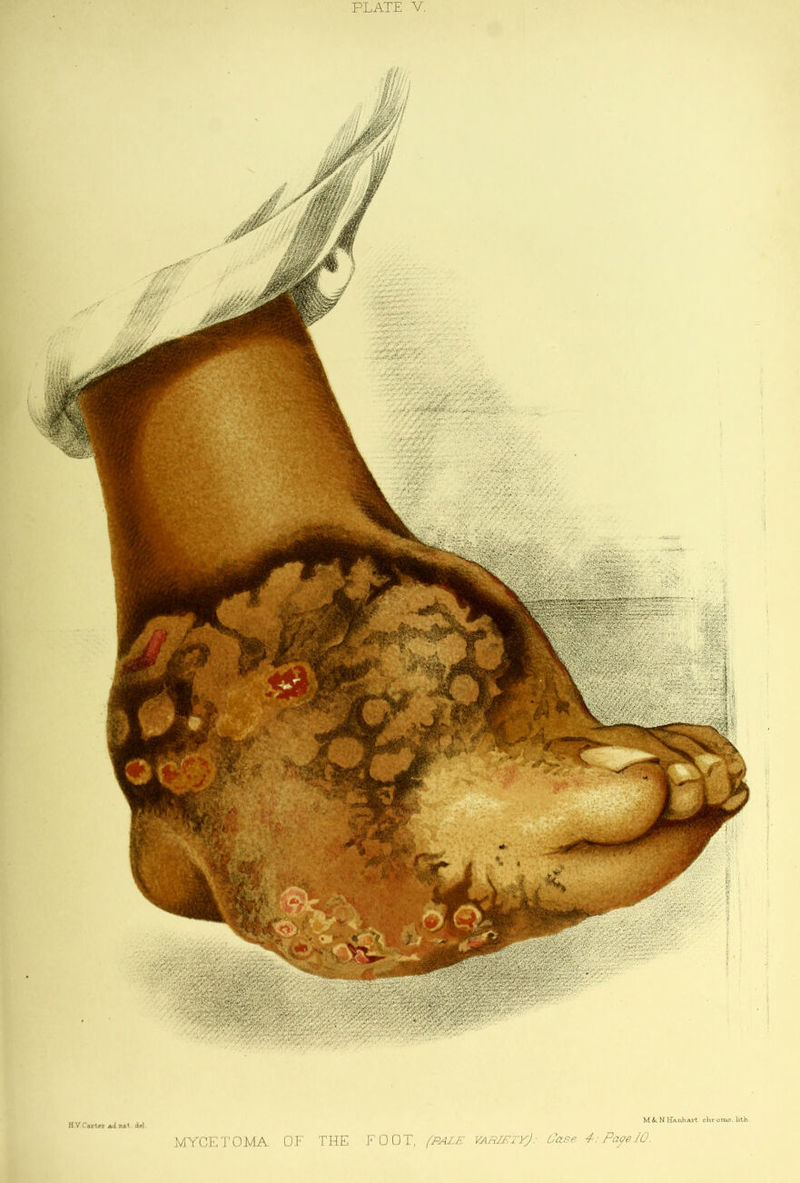 i ! s H V Cfliier Acl nM del. M M BT*-iihA.rt cKroiiu?. litb MYCETOMA OF TFIE FOOT, fB4JLE VARIETvJ: Case 4:Pa^eI0.