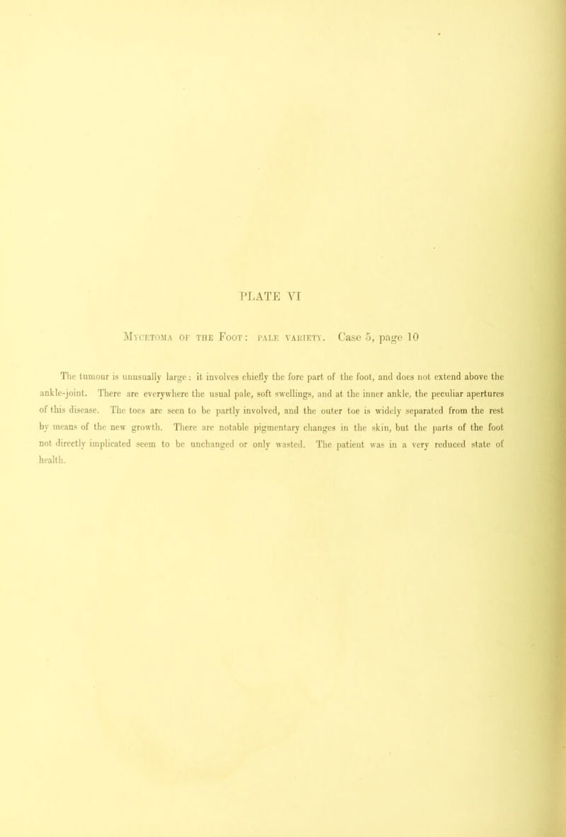 T’Latp: Yi IMvcktoma of the Foot: fale vaihetv. (.’ase 5, page 10 The tumour is uuusually large: it involves chiefly the fore part of the foot, and does not extend above the ankle-joint. There are everywhere the usual pale, soft swellings, and at the inner ankle, the peculiar apertures of this disease. The toes arc seen to be partly involved, and the outer toe is widely separated from the rest by means of the new growth. Tliere are notable pigmentary clianges in the skin, but the parts of the foot not directly implicated seem to be unchanged or only wasted. The patient was in a very reduced state of health.