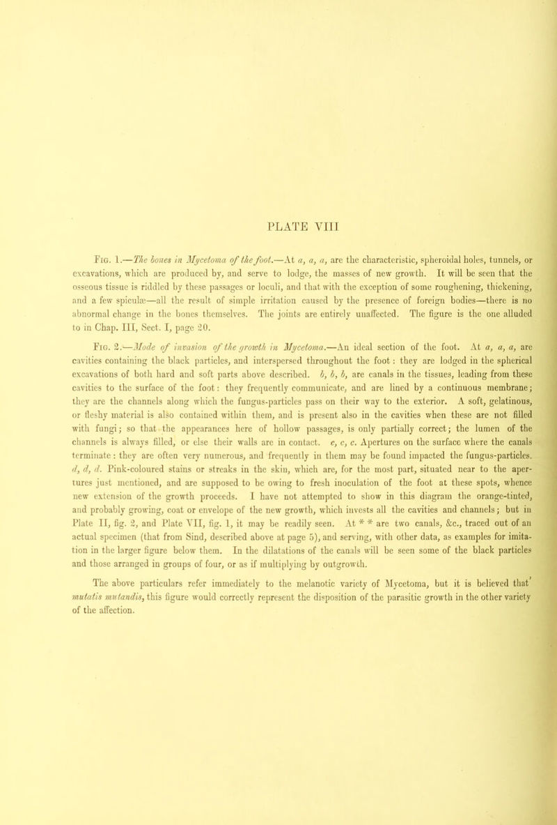 Fig. 1.—The hones in Mycetoma of the foot.—At a, a, a, are the characteristic, spheroidal holes, tunnels, or excavatioTis, which are produced by, and serve to lodge, the masses of new growth. It will be seen that the osseous tissue is riddled by these passages or loculi, and that with the exception of some rougliening, thickening, and a few spicula’.—all the result of simple irritation caused by the presence of foreign bodies—there is no abnormal change in the bones themselves. The joints are entirely unaffected. The figure is the one alluded to in Chap. Ill, Sect. I, page 20. Fig. 2.—2lode of invasion of the groioth in Mycetoma.—An ideal section of the foot. At a, a, a, are cavities containing the black particles, and interspersed throughout the foot: they are lodged in the spherical excavations of both hard and soft parts above described, h, b, h, are canals in the tissues, leading from these cavities to the surface of the foot: they frequently communicate, and are lined by a continuous membrane; they are the channels along which the fungus-particles pass on their way to the exterior. A soft, gelatinous, or fleshy material is also contained within them, and is jircsent also in the cavities when these are not filled with fungi; so that the appearances here of hollow passages, is only partially correct; the lumen of the channels is always filled, or else their walls are in contact, c, c, c. Apertures on the surface where the canals terminate: they are often very numerous, and frequently in them may be found impacted the fungus-particles. (I, d, d. Pink-coloured stains or streaks in the skin, which are, for the most part, situated near to the aper- tures just mentioned, and are supposed to be owing to fresh inoculation of the foot at these spots, whence new extension of the growth proceeds. I have not attempted to show in this diagram the orange-tinted, and probably growing, coat or envelope of the new growth, which invests all the cavities and channels; but in Plate II, fig. 2, and Plate All, fig. 1, it may be readily seen. At * * are two canals, &c., traced out of an actual specimen (that from Sind, described above at page 5), and serving, with other data, as examples for imita- tion in the larger figure below them. In the dilatations of the canals will be seen some of the black particles and those arranged in groups of four, or as if multiplying by outgrowth. The above particulars refer immediately to the melanotic variety of Mycetoma, but it is believed that mutatis mutandis, this figure would correctly represent the disposition of the parasitic growth in the other variety of the affection.