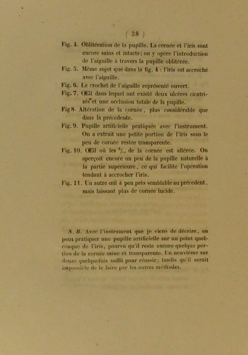 Fig. 4. Oblitération de la pupille. La cornée et l’iris sont encore sains et intacts; on y opère l’introduction de l’aiguille à travers la pupille oblitérée. Fig. 3. Même sujet que dans la fig. 4 : l’iris est accroché avec l'aiguille. Fig. 6. Le crochet de l’aiguille représenté ouvert. Fig. 7. Œil dans lequel ont existé deux ulcères cicatri- séset une occlusion totale de la pupille. Fig8. Altération de la cornée, plus considérable que dans la précédente. Fig. 9. Pupille artificielle pratiquée avec l’instrument. On a extrait une petite portion de l’iris sous le peu de cornée restée transparente. Fig. 10. Œil où les 6Jl0 de la cornée est altérée. On aperçoit encore un peu de la pupille naturelle à la partie supérieure, ce qui facilite l’opération tendant à accrocher l’iris. Fig. 11. Un autre œil à peu près semblable au précédent, mais laissant plus de cornée lucide. /V. H. Avec l'instrument que je viens de décrire, on peut pratiquer une pupille artificielle sur un point quel- conque de l’iris, pourvu qu’il reste encore quelque por- tion de la cornée saine cl transparente, lii neuvième sur douze quelquefois suffit pour réussir; tandis qu’il serait impossible de le faire par les autres méthodes.