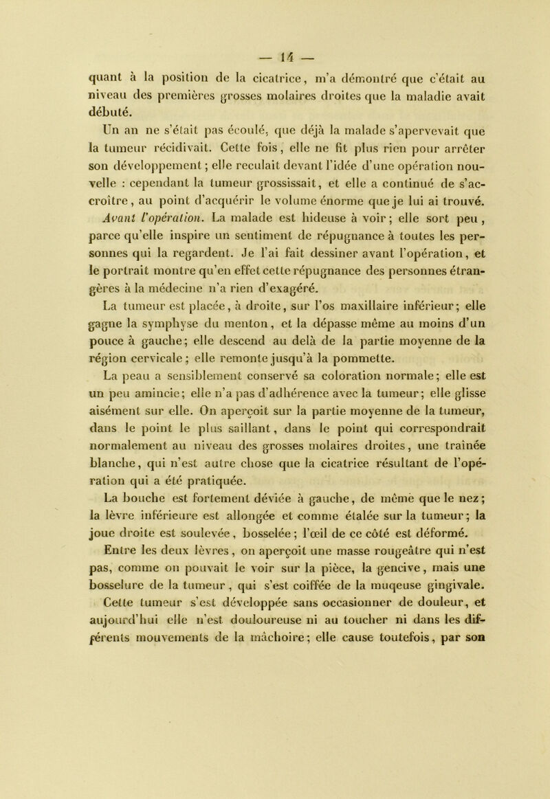 quant à la position de la cicatrice, m’a démontré que c’était au niveau des premières grosses molaires droites que la maladie avait débuté. Un an ne s’était pas écoulé, que déjà la malade s’apervevait que la tumeur récidivait. Cette fois, elle ne fit plus rien pour arrêter son développement ; elle reculait devant l’idée d’une opération nou- velle : cependant la tumeur grossissait, et elle a continué de s’ac- croître, au point d’acquérir le volume énorme que je lui ai trouvé. A{^a}it L*opération. La malade est hideuse à voir; elle sort peu, parce qu’elle inspire un sentiment de répugnance à toutes les per- sonnes qui la regardent. Je l’ai fait dessiner avant l’opération, et le portrait montre qu’en effet cette répugnance des personnes étran- gères à la médecine n’a rien d’exagéré. La tumeur est placée, à droite, sur l’os maxillaire inférieur; elle gagne la symphyse du menton, et la dépasse même au moins d’un pouce à gauche; elle descend au delà de la partie moyenne de la région cervicale; elle remonte jusqu’à la pommette. La peau a sensiblement conservé sa coloration normale ; elle est un peu amincie; elle n’a pas d’adhérence avec la tumeur; elle glisse aisément sur elle. On aperçoit sur la partie moyenne de la tumeur, dans le point le plus saillant, dans le point qui correspondrait normalement au niveau des grosses molaires droites, une traînée blanche, qui n’est autre chose que la cicatrice résultant de l’opé- ration qui a été pratiquée. La bouche est fortement déviée à gauche, de même que le nez ; la lèvre inférieure est allongée et comme étalée sur la tumeur; la joue droite est soulevée, bosselée ; l’œil de ce côté est déformé. Entre les deux lèvres, on aperçoit une masse rougeâtre qui n’est pas, comme on pouvait le voir sur la pièce, la gencive, mais une bosselure de la tumeur, qui s’est coiffée de la muqeuse gingivale. Cette tumeur s’est développée sans occasionner de douleur , et aujourd’hui elle n’est douloureuse ni au toucher ni dans les dif- férents mouvements de la mâchoire; elle cause toutefois, par son