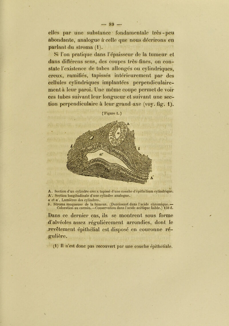 elles par une substance • fondamentale très-peu abondante, analog’ue à-celle que nous décrirons en parlant du stroma (1). Si l’on pratique dans l’épaisseur de la tumeur et dans diftérens sens, des coupes très-fines, on con- state l’existence de tubes allong'és ou cylindriques, creux, ra.mifiés, tapissés intérieurement par des cellules cylindriques implantées perpendiculaire- ment à leur paroi. Une même coupe permet de voir ces tubes suivant leur long’ueur et suivant une sec- tion perpendiculaire à leur g-rand axe (voy. fig*. 1). A. Section d’un cylindre creux tapissé d’une couche d’épithélium cylindrique. A'. Section longitudinale d’une cylindre analogue. a et a’. Lumières des cylindres. b. Stroma muqueuse de la tumeur. (Durcissant dans l’acide chromique.— Coloration au carmin.—Conservation dans l’acide acétique faible.) 150 d. Dans ce dernier cas, ils se montrent sous forme d’alvéoles assez rég*ulièrement arrondies, dont le .revêtement épithélial est disposé en couronne ré- g’ulière. (1) Il n’est donc pas recouvert par une couche épitheliale.